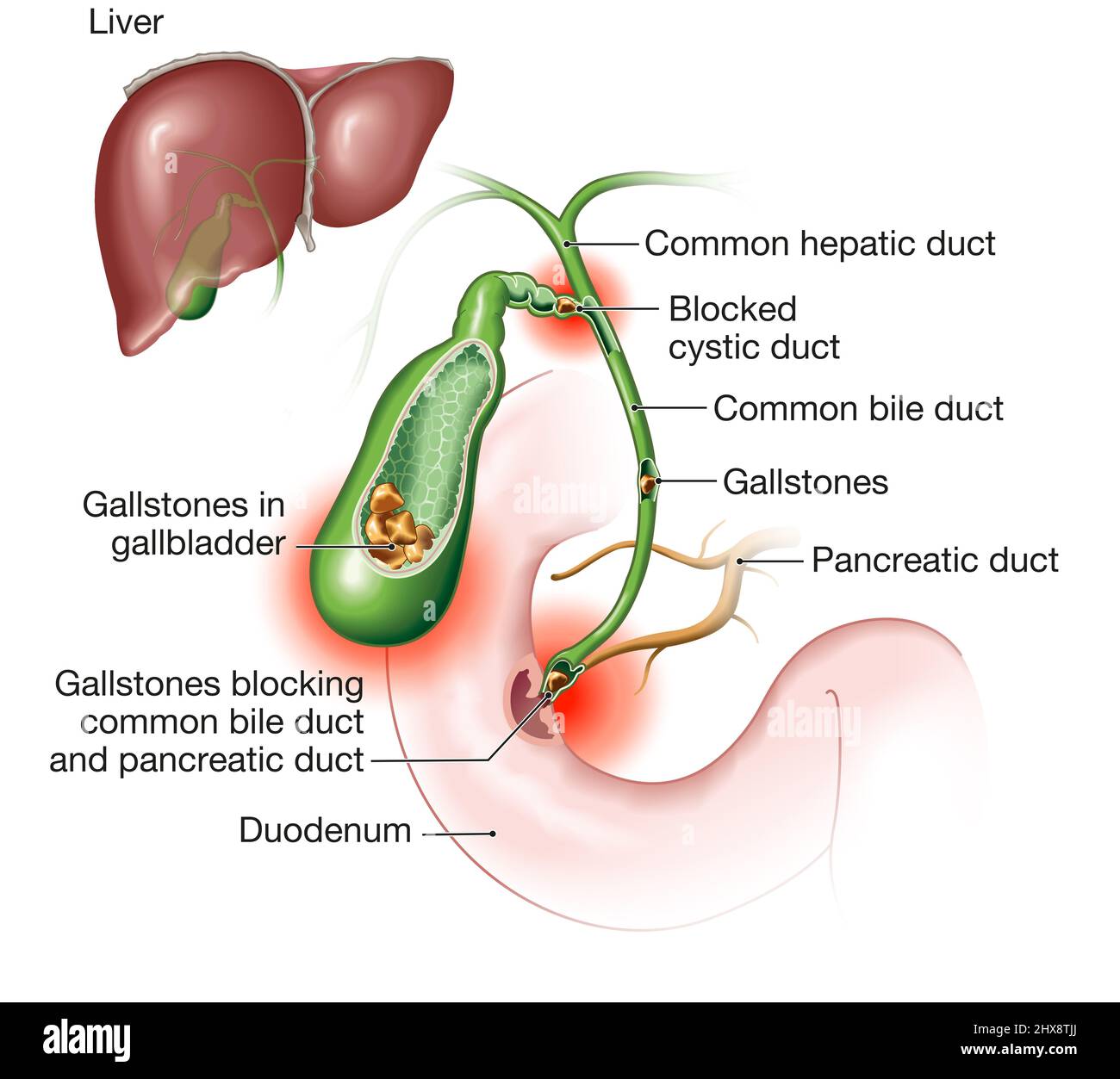 Gallensteinkrankheit. Gallensteine blockieren den Gallengang und den Pankreasgang. Beschriftete Abbildung Stockfoto