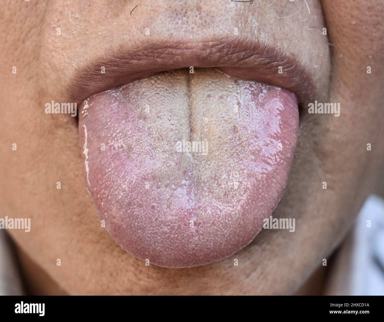 Zerrissende Zunge des älteren Mannes aus Südostasien. Sie ist durch eine tiefe, markante Nut in der Mitte gekennzeichnet. Stockfoto