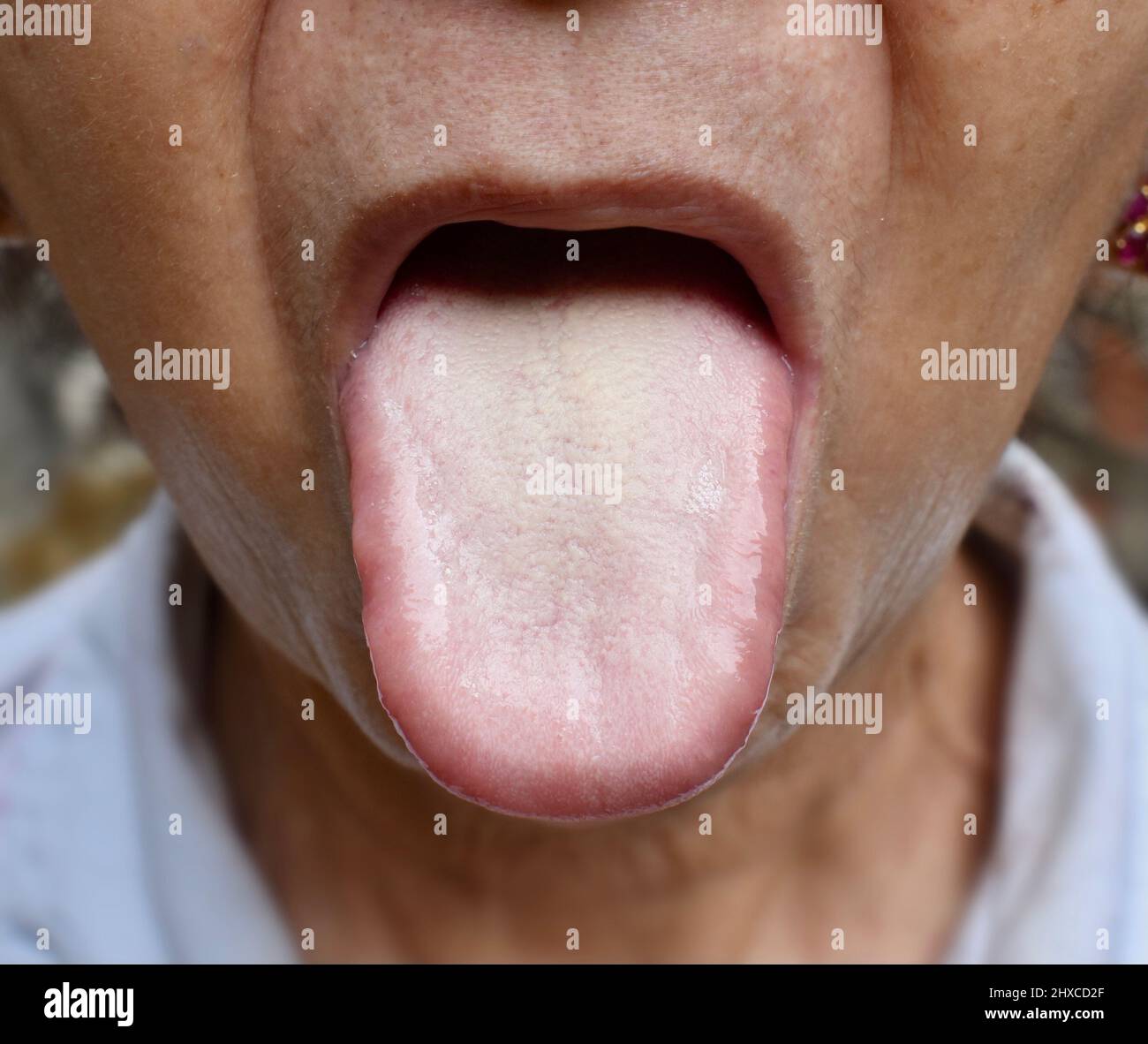 Beschichtete Zunge oder weiße Zunge einer asiatischen, chinesischen Frau. Es erscheint mit weißer Schicht, wenn sich Rückstände, Bakterien und abgestorbene Zellen zwischen vergrößerten Zellen vermehren Stockfoto