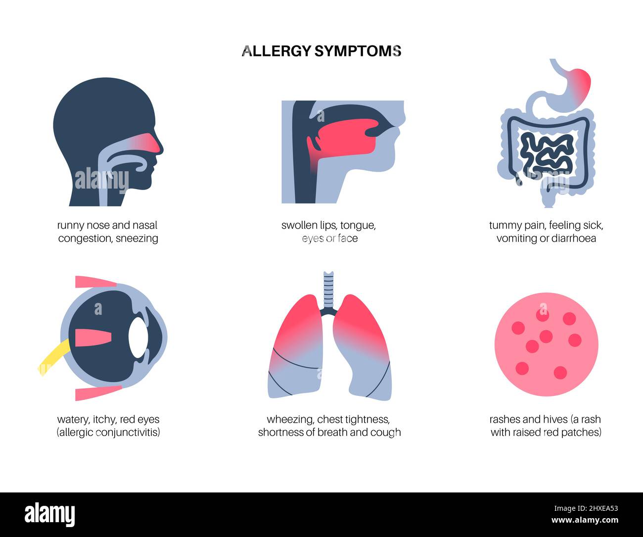 Allergiesymptome, konzeptionelle Illustration Stockfoto