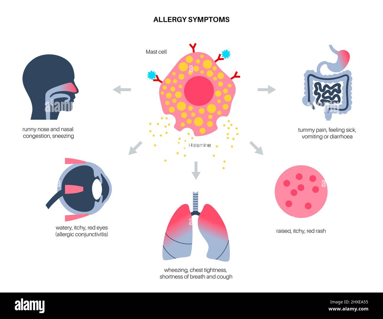 Allergiesymptome, konzeptionelle Illustration Stockfoto