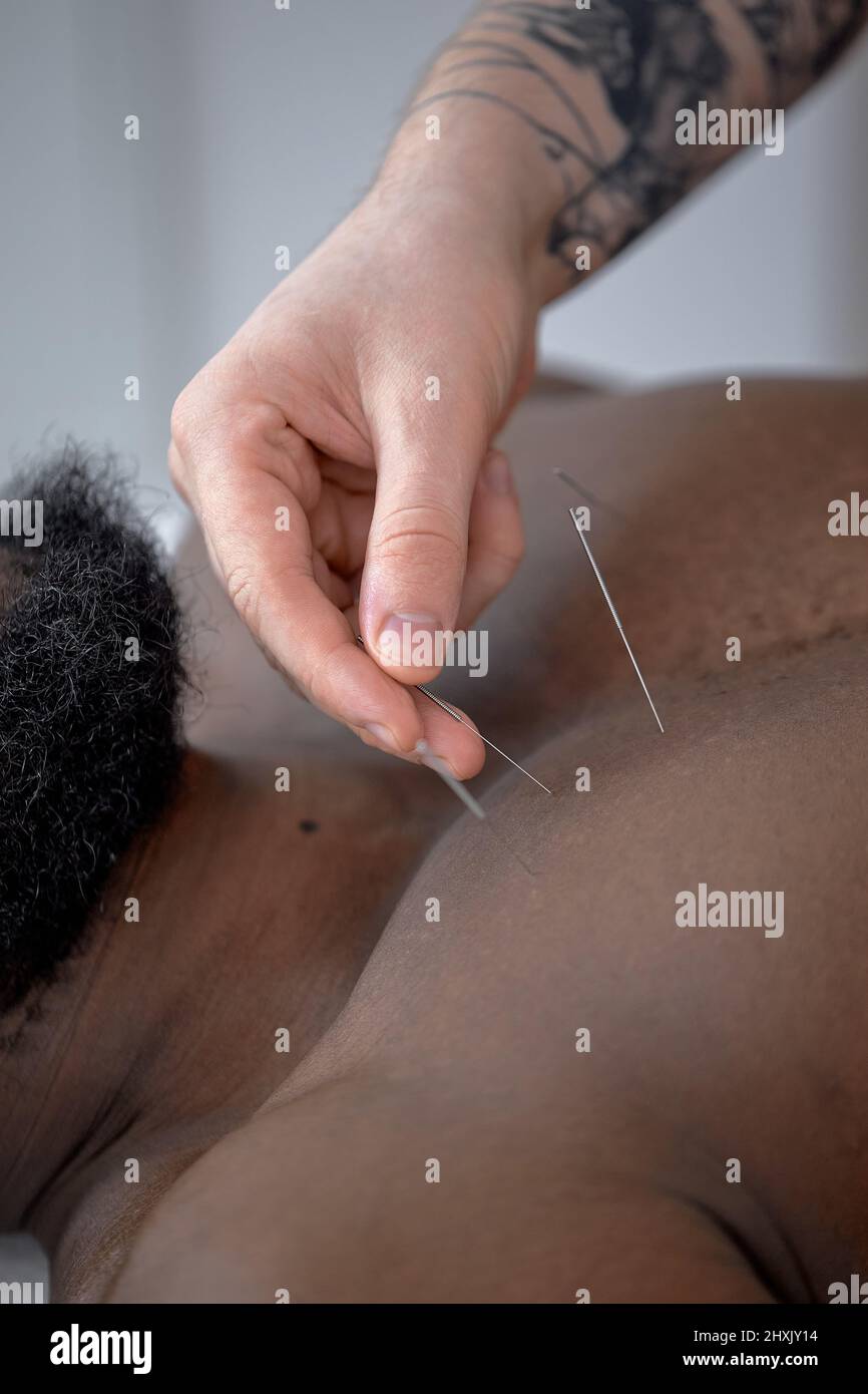 Cropped Acupuncturist behandelt die Krankheit eines männlichen Patienten mit Akupunktur an speziellen Punkten auf der Brust. Akupunktur ist alternative Medizin. Zugeschnittenes schwarzes gu Stockfoto