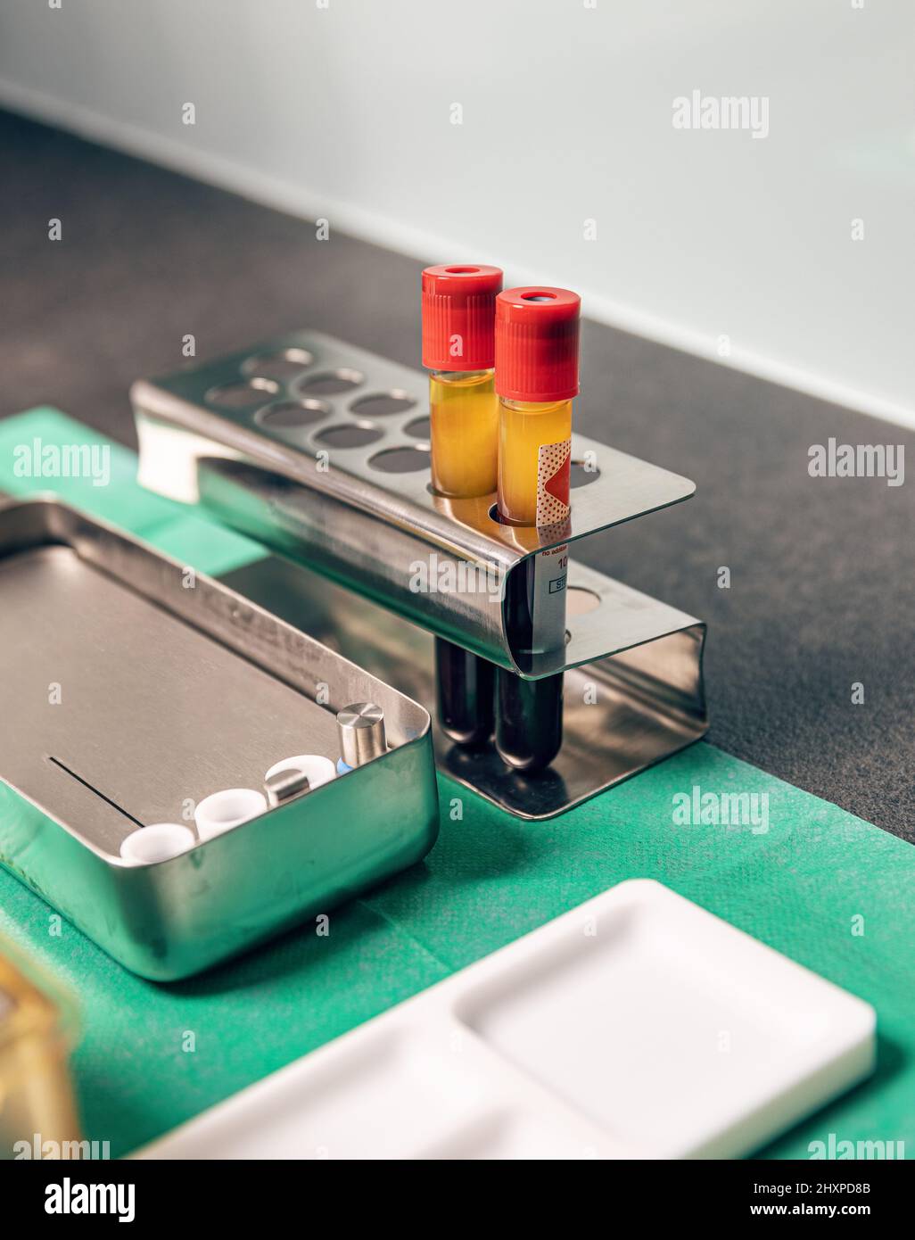 PRF Plättchen reiche Fibrintherapie Blutschlauch Gel für die zahnärztliche Behandlung Stockfoto