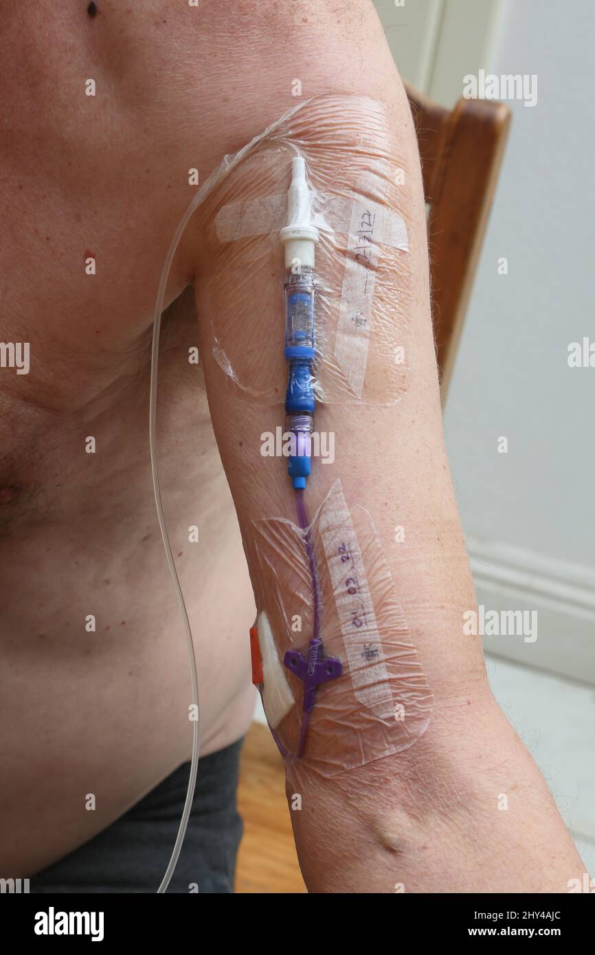 Mann, der mit Natriumchlorid Fluorouracil cytotoxic Drug für kontinuierliche intravenöse Infusion Chemotherapie Medikamente zu Hause durch Picc-Linie im Oberarm behandelt - Behandlung von Krebs Surrey England Stockfoto