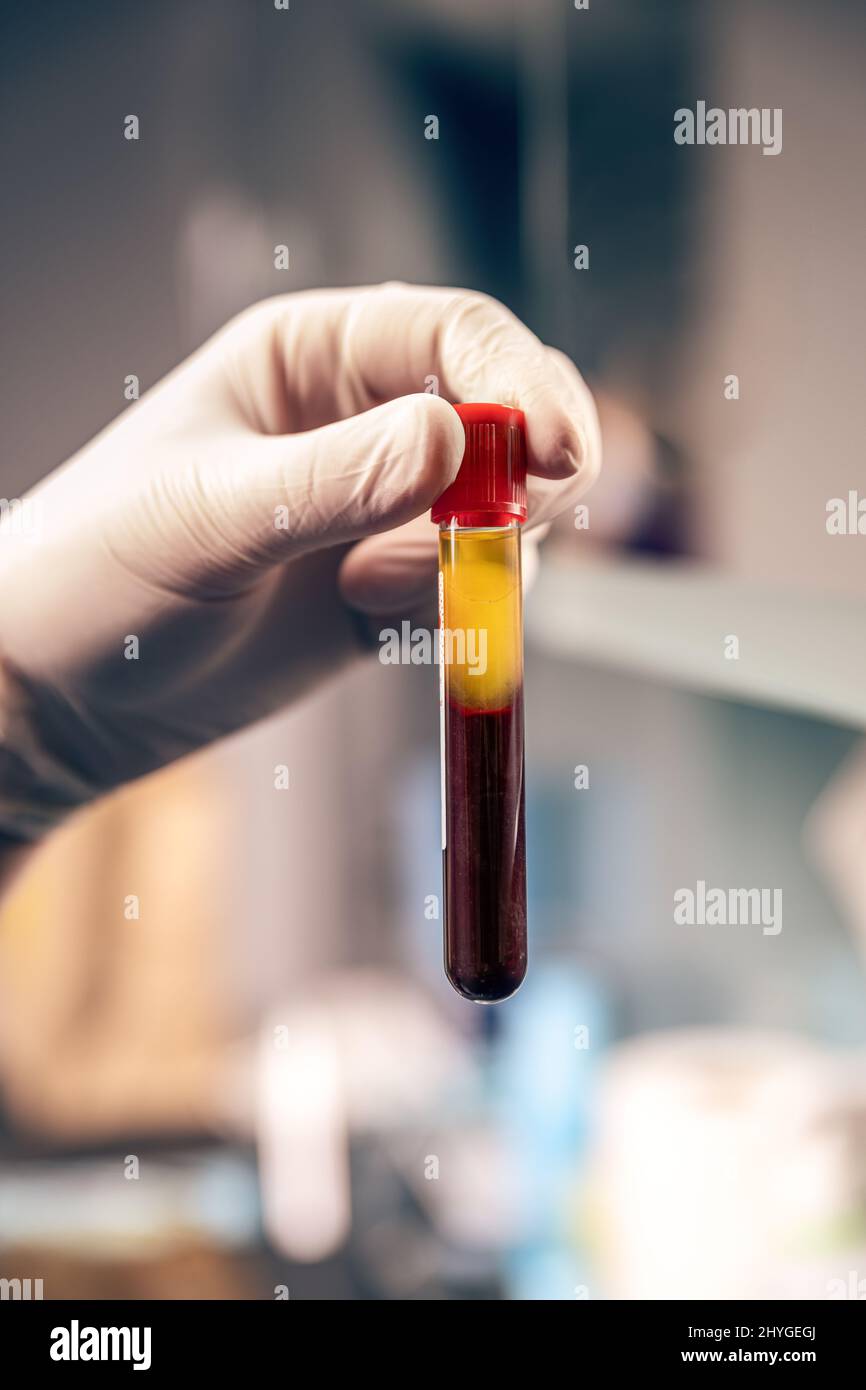 Extraktion von Plasma aus Blut in der Hand im Reagenzglas Stockfoto