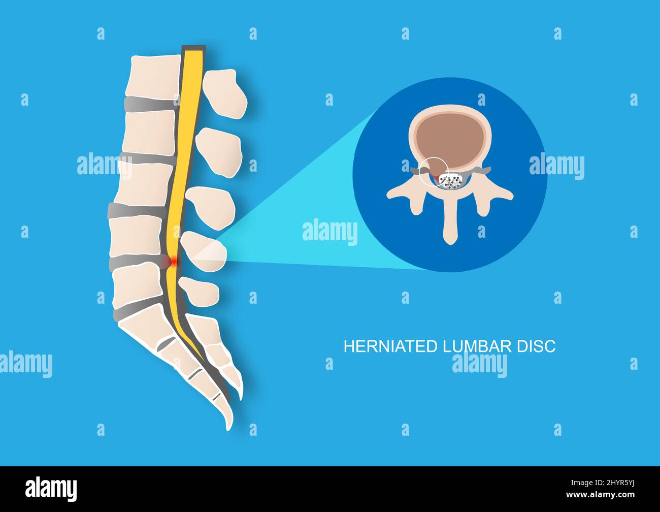 Vektordarstellung von Rückenschmerzen durch Bandscheibenvorfall der Lendenwirbelscheibe. Bandscheibenprotusion, die eine Kompression der Nervenwurzel verursacht. Stock Vektor