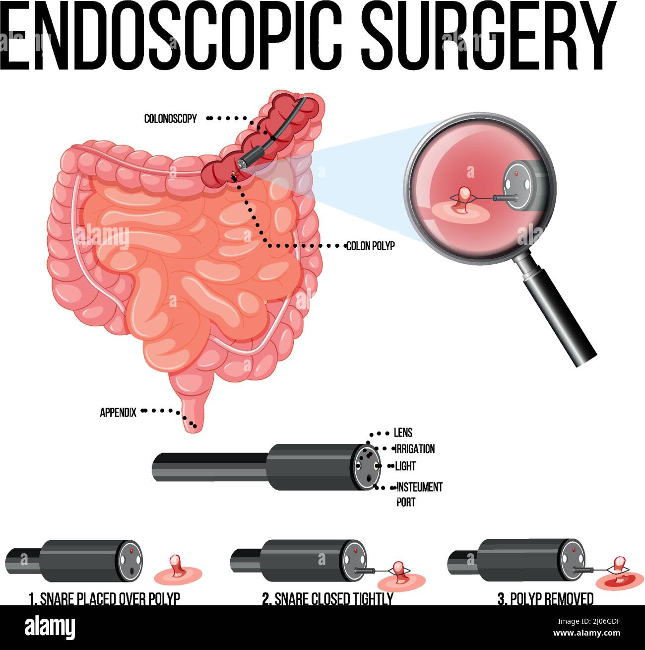 Abbildung zeigt die Illustration einer endoskopischen Operation Stock Vektor