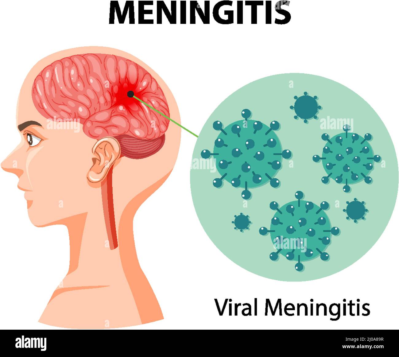 Abbildung einer Meningitis im menschlichen Gehirn Stock Vektor