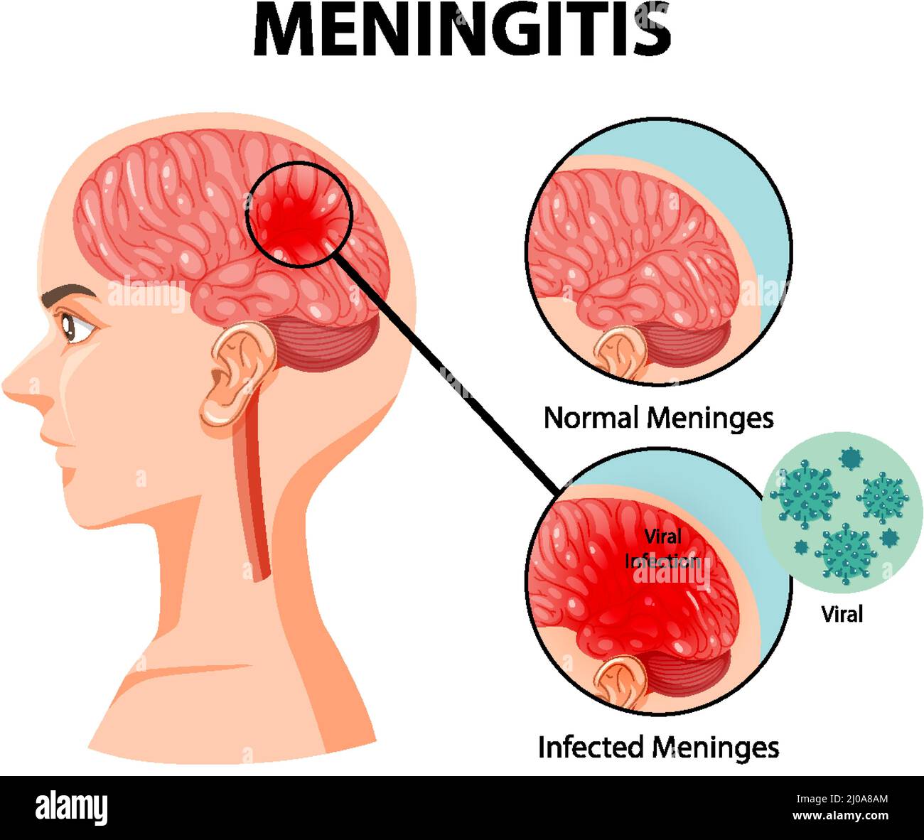 Abbildung einer Meningitis im menschlichen Gehirn Stock Vektor