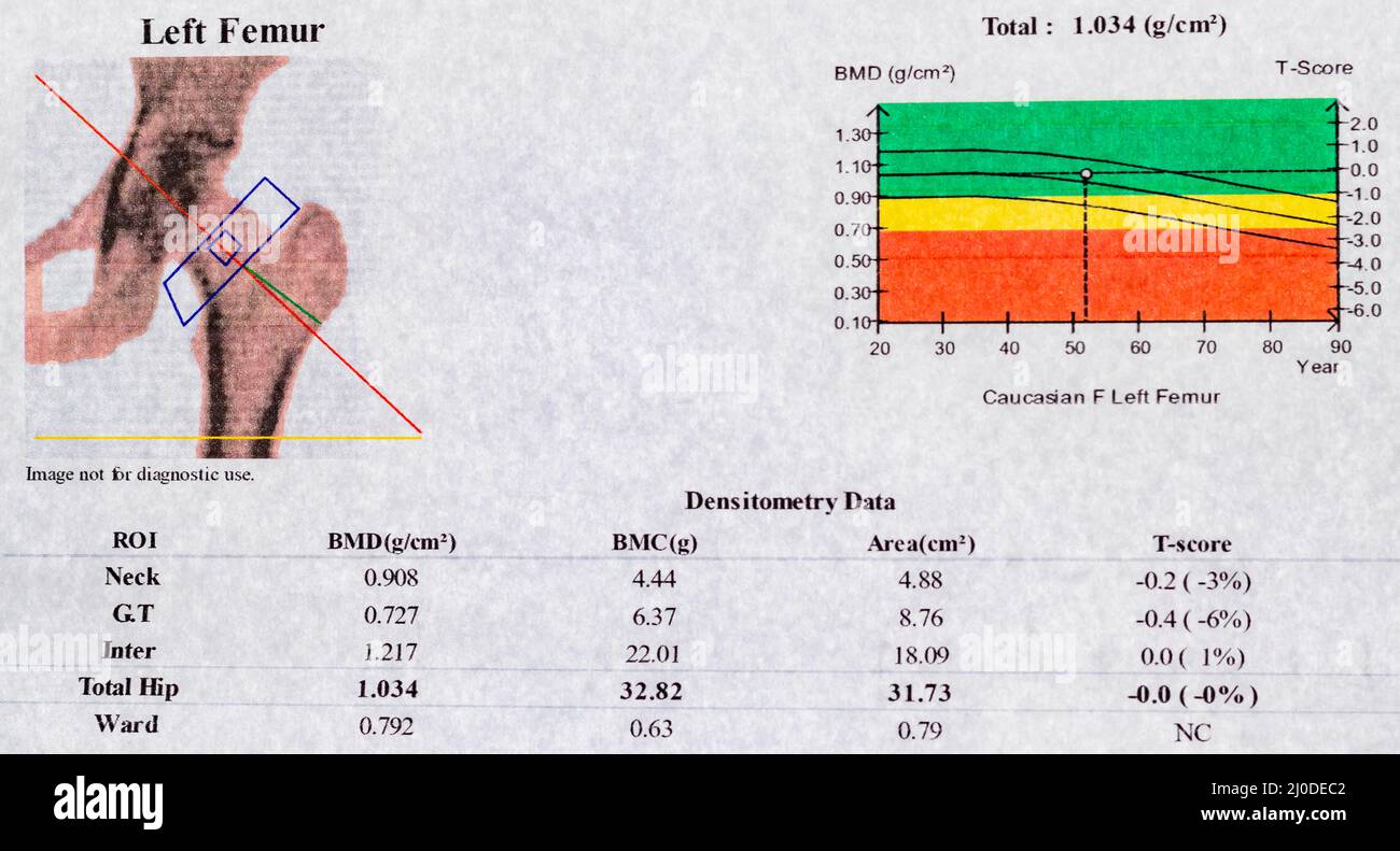 DEXA Densitometry Report of Left femoral Scan; Diagramm und Kurve der Werte ​​used zur Untersuchung der Osteoporose bei Frauen in der Menopause Stockfoto