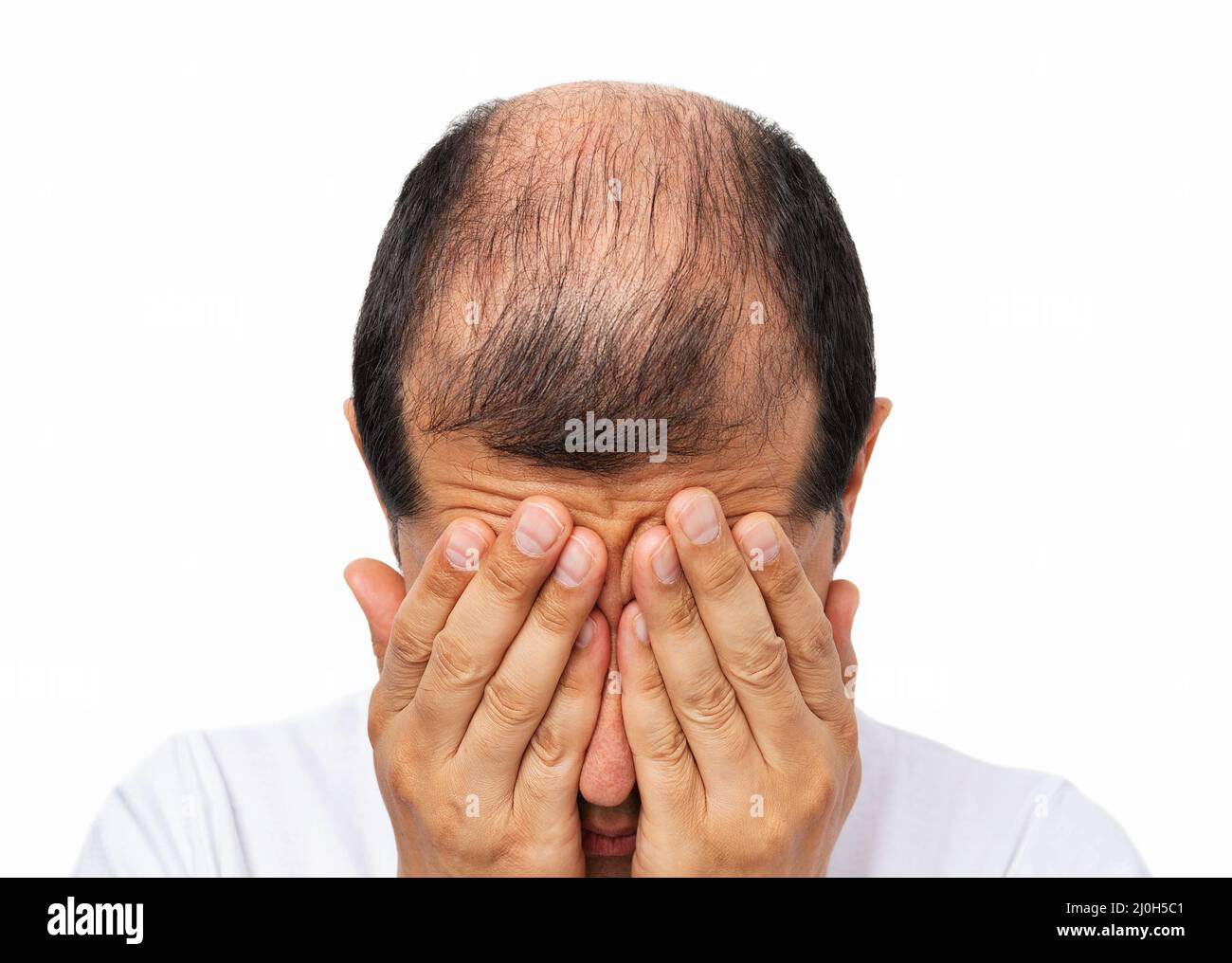 Close-uo von Glatze Mann durch schnellen Haarausfall vor weißem Hintergrund betont Stockfoto