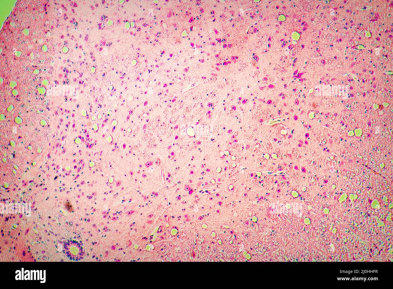 Gewebeschichtbiopsie zur Untersuchung auf einen bösartigen Tumor. Blick im Mikroskop Stockfoto
