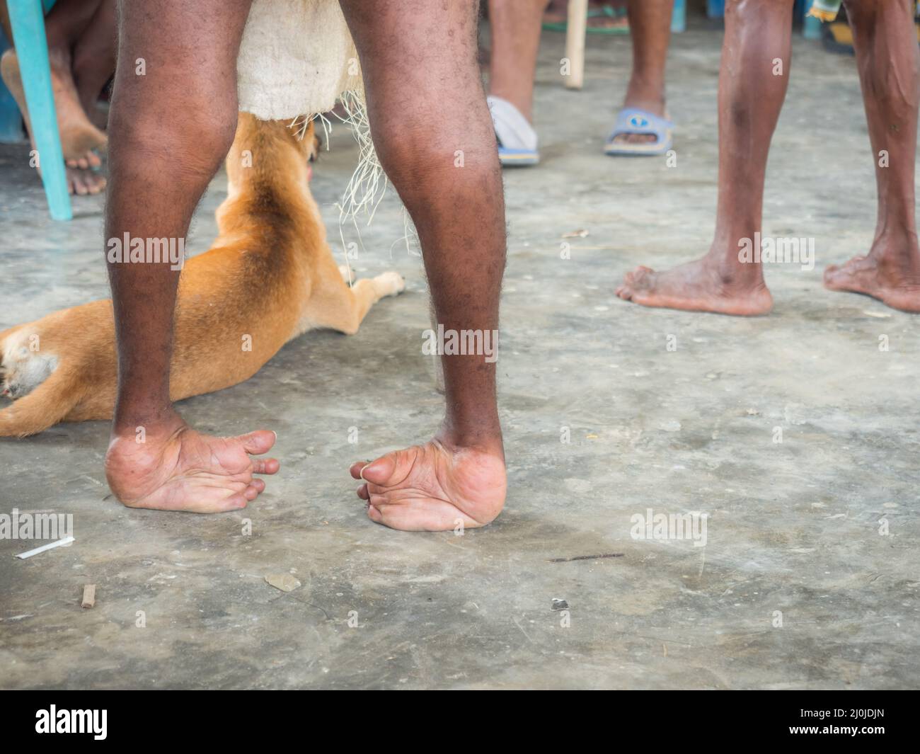 Eine Person mit Beinverformungen aufgrund von Polio oder anderen Krankheiten inmitten des indonesischen Dschungels Bird's Head Peninsula, West Papua, Indonesien, Asien Stockfoto