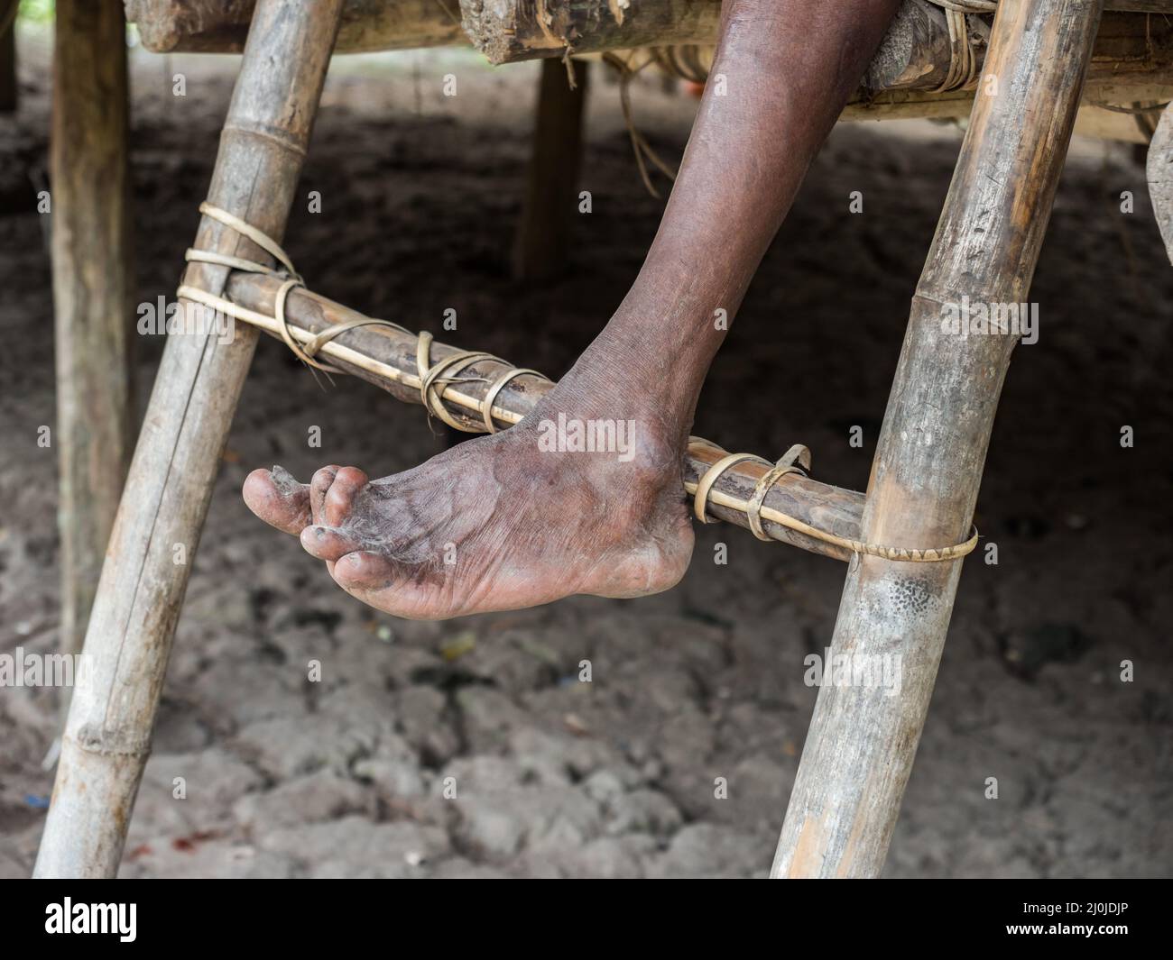 Eine Person mit Beinverformungen aufgrund von Polio oder anderen Krankheiten inmitten des indonesischen Dschungels Bird's Head Peninsula, West Papua, Indonesien, Asien Stockfoto