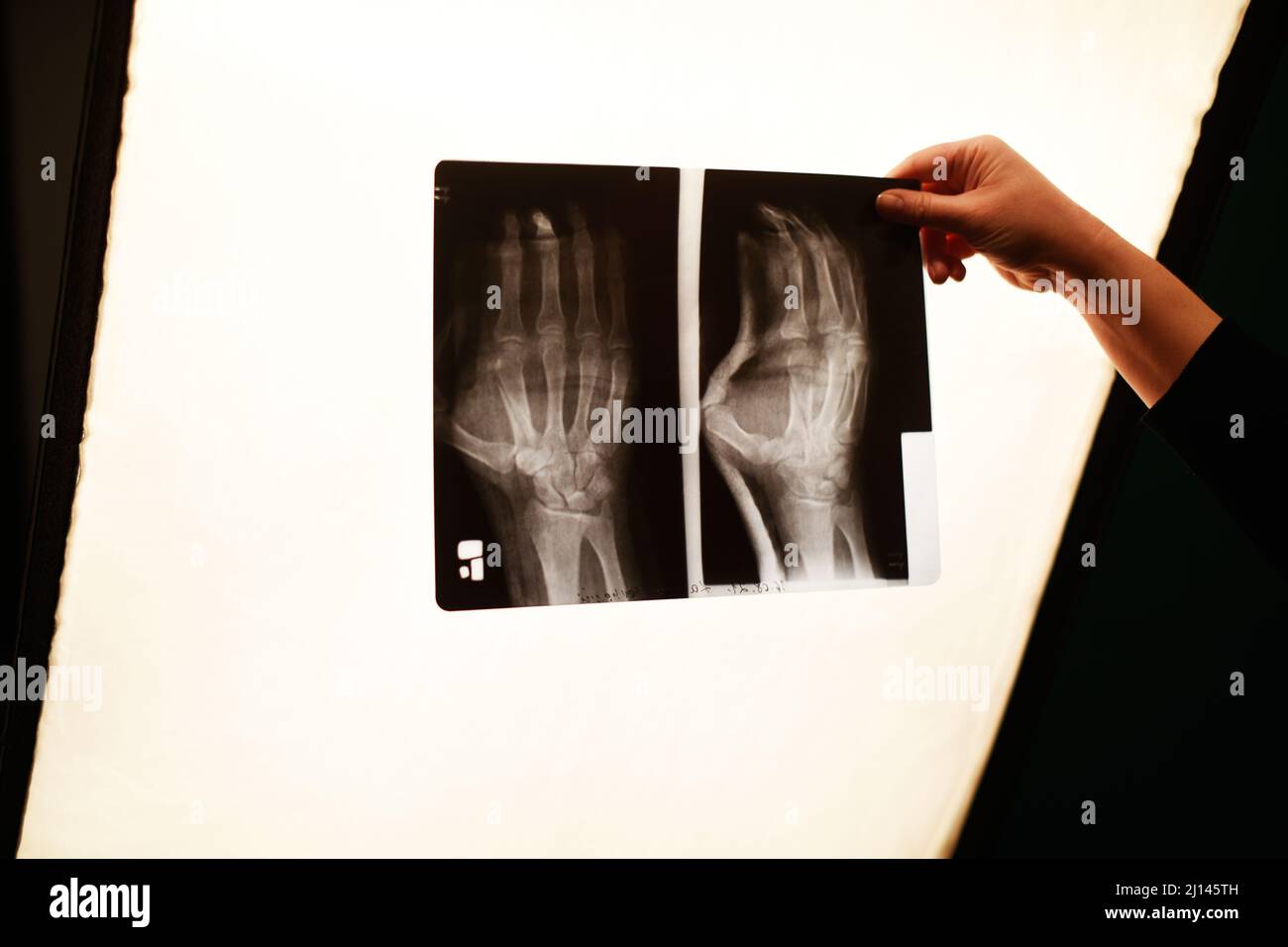 Die Hand der Krankenschwester hält ein Röntgenbild des Armes. Armbruch, Medizin. Stockfoto