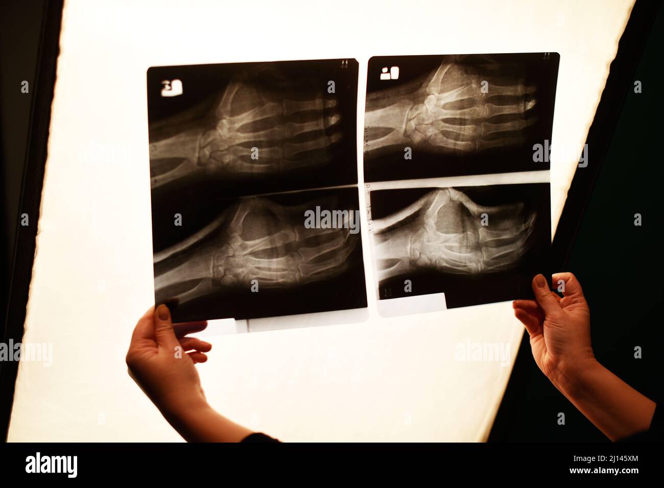 Die Hand der Krankenschwester hält ein Röntgenbild des Armes. Armbruch, Medizin. Stockfoto