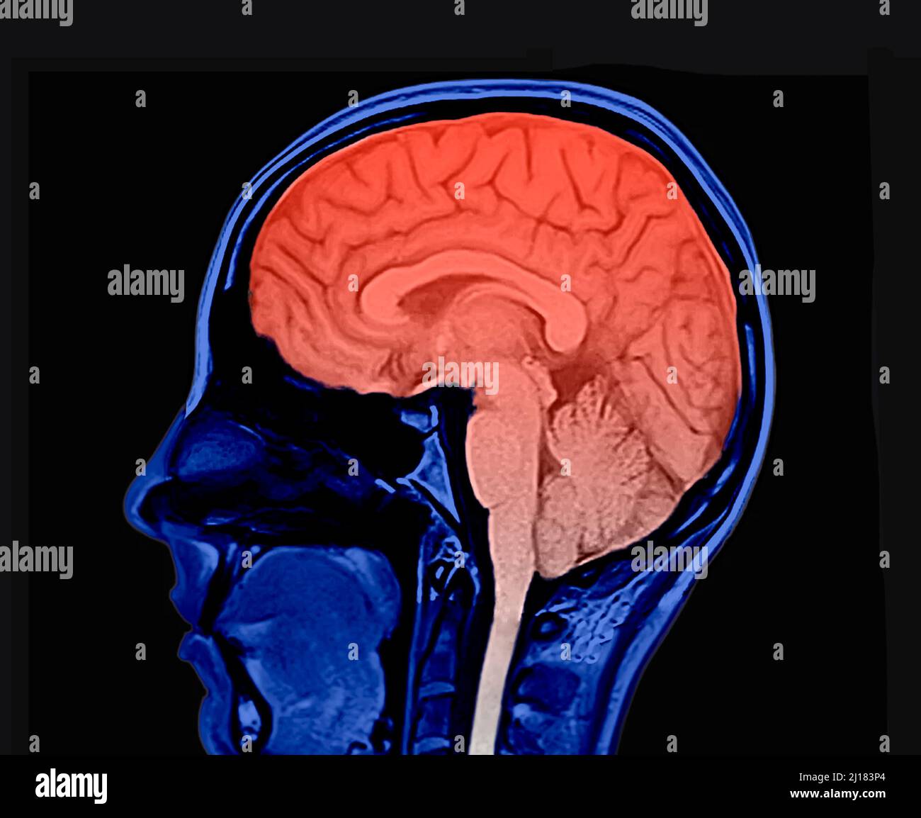 Kolorierte Version eines Magnetresonanzbildes des menschlichen Gehirns. Sagittale Ansicht. Zeigt den Kopf, den Hippocampus, das Zerebellum und das Rückenmark. Achtung. Stockfoto