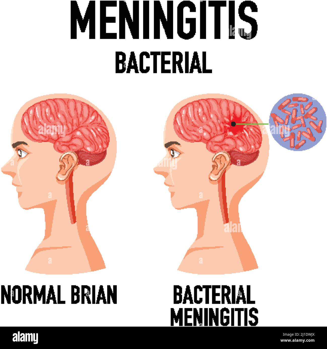 Diagramm zeigt Meningitis bakteriell im Gehirn Illustration Stock Vektor