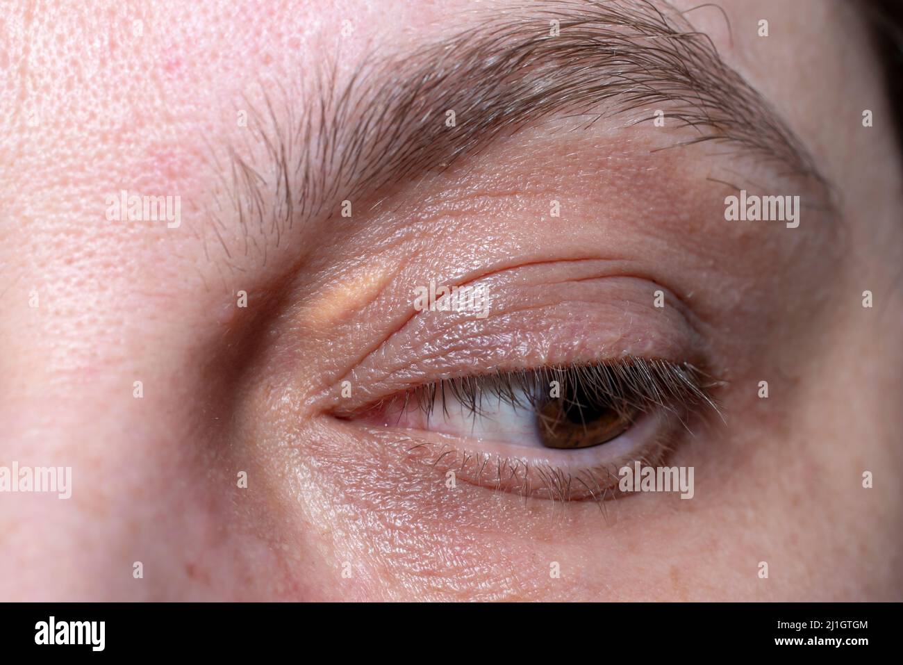 Xanthelasma, erhöhtes gelbliches Wachstum auf den Augenlidern, Makroaufnahme Stockfoto