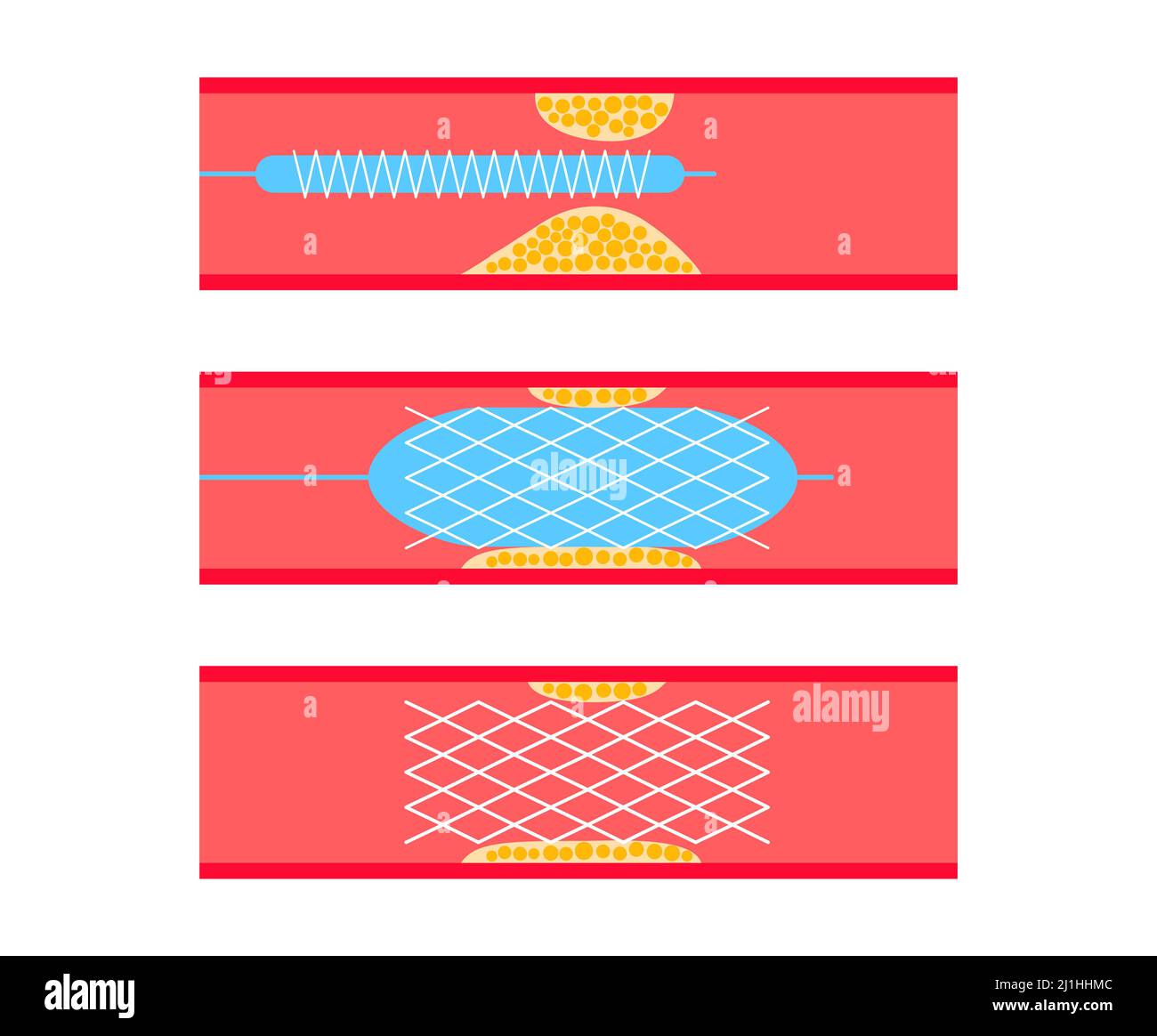 Angioplastie, Illustration Stockfoto