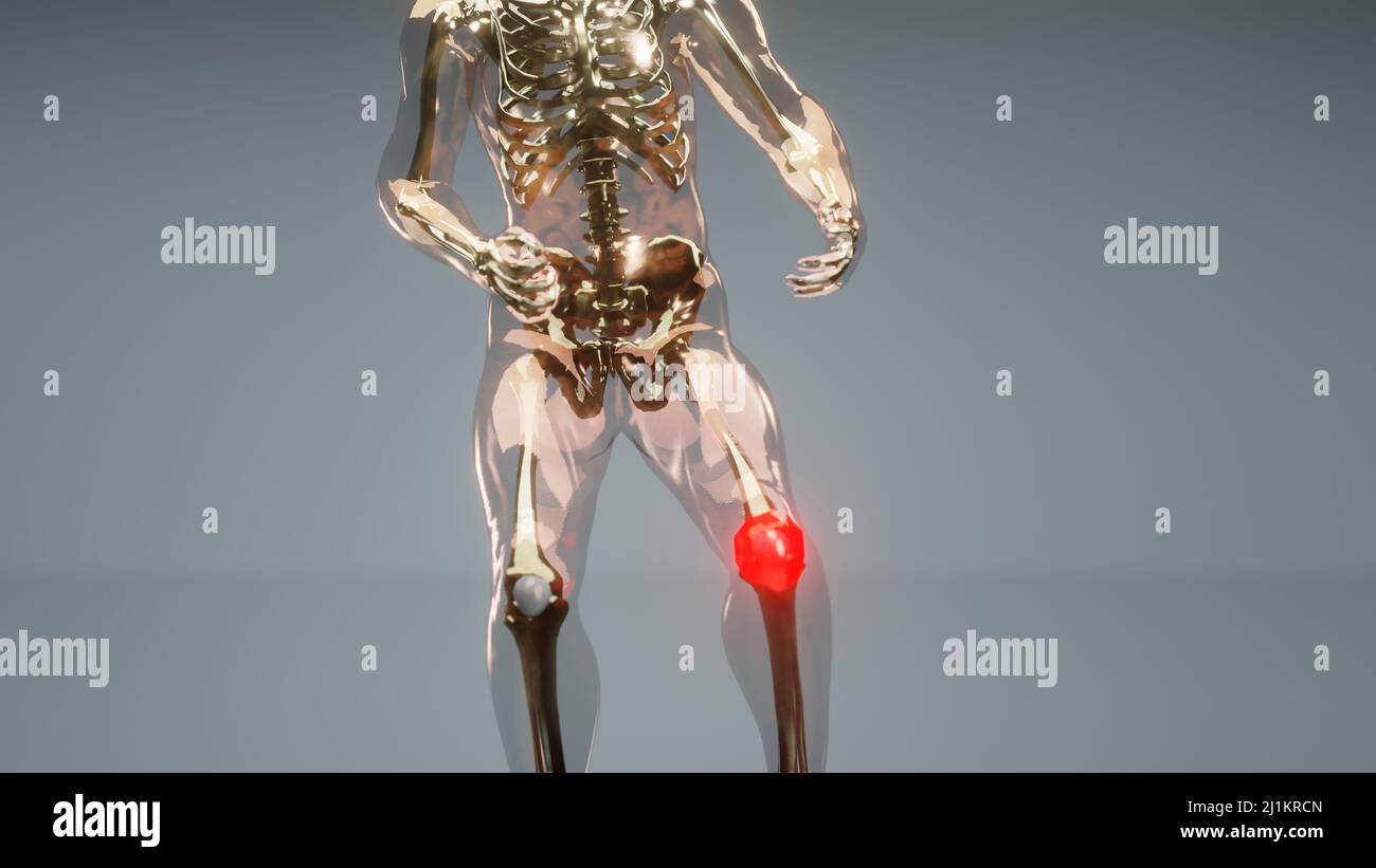 Knie Anatomie Fotos Und Bildmaterial In Hoher Aufl sung Alamy knie-anatomie-fotos-und-bildmaterial-in-hoher-aufl-sung-alamy