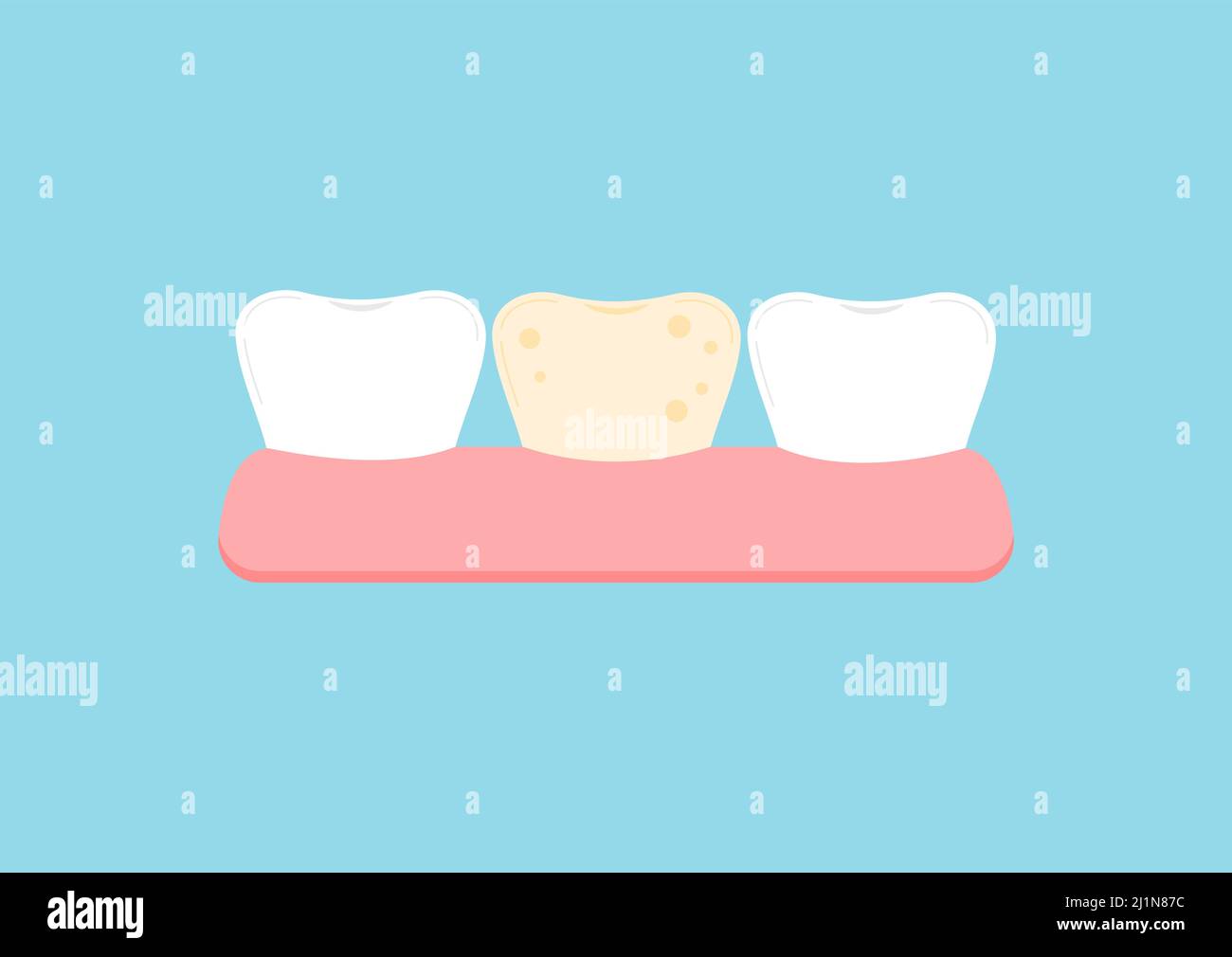 Weißer Zahn und ein Zahn mit gelbem Plaque-Symbol. Stock Vektor