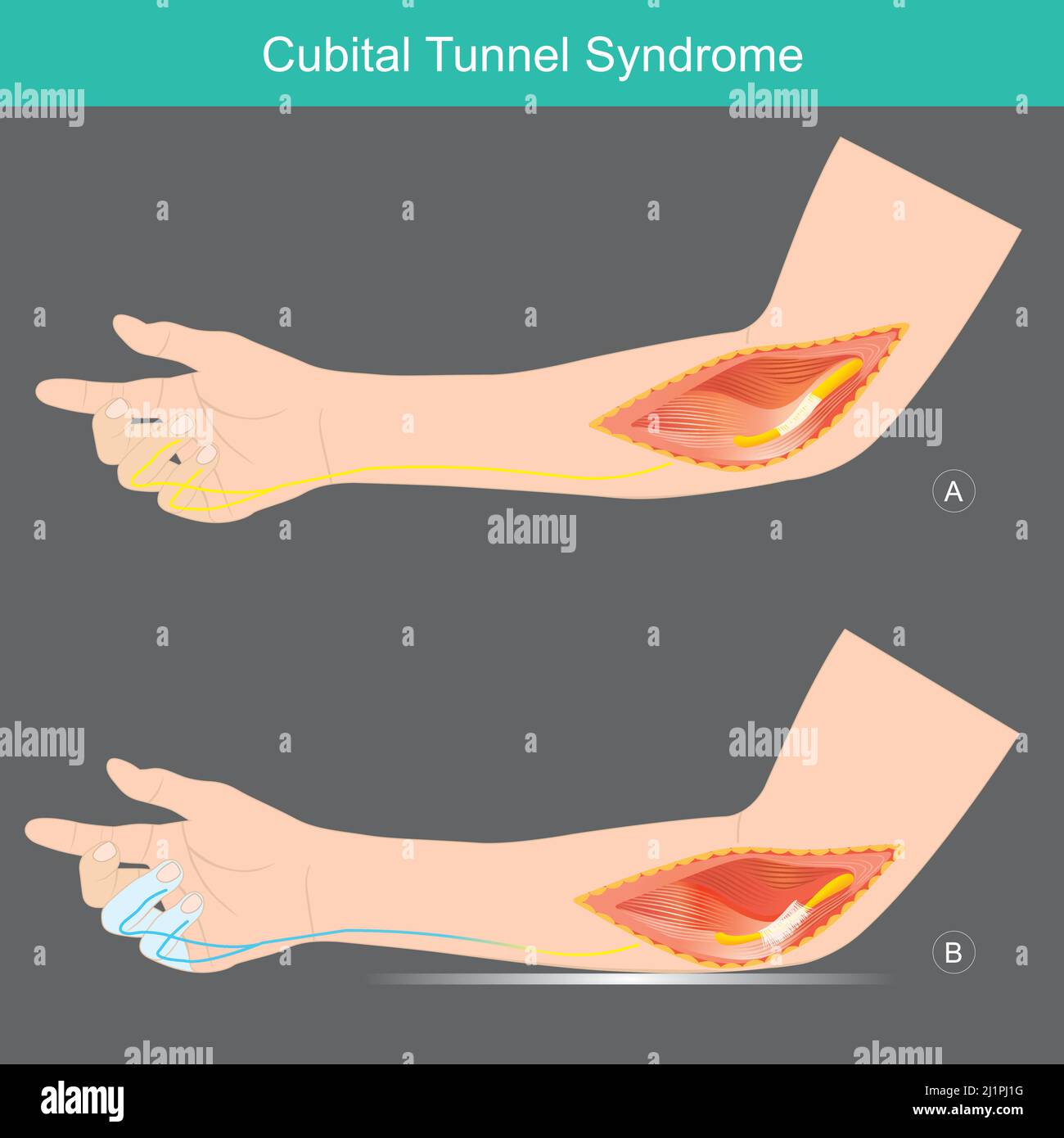Kubitales Tunnel-Syndrom. Ein Zustand, der Druck oder Dehnung des Ulnarnervs in den Armen beinhaltet, was Taubheit oder Kribbeln im Ring verursachen kann Stock Vektor