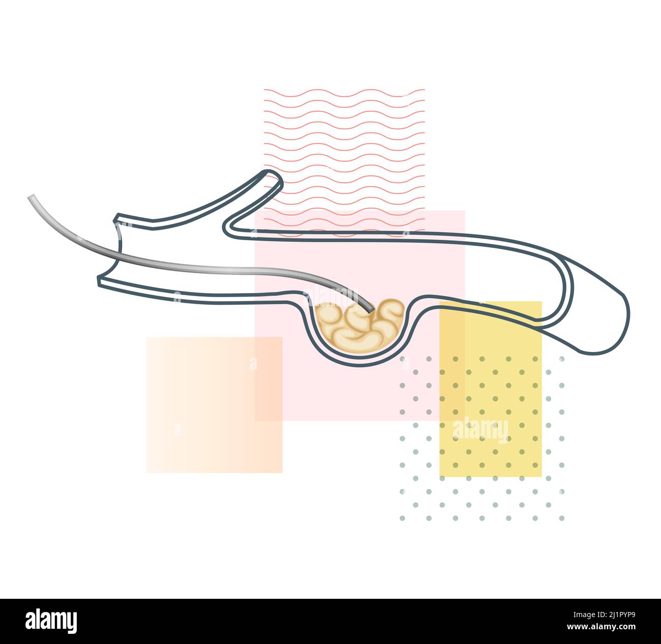 Aneurysma mit vaskulärem Stent-Verfahren – Stockdarstellung als EPS 10-Datei Stock Vektor