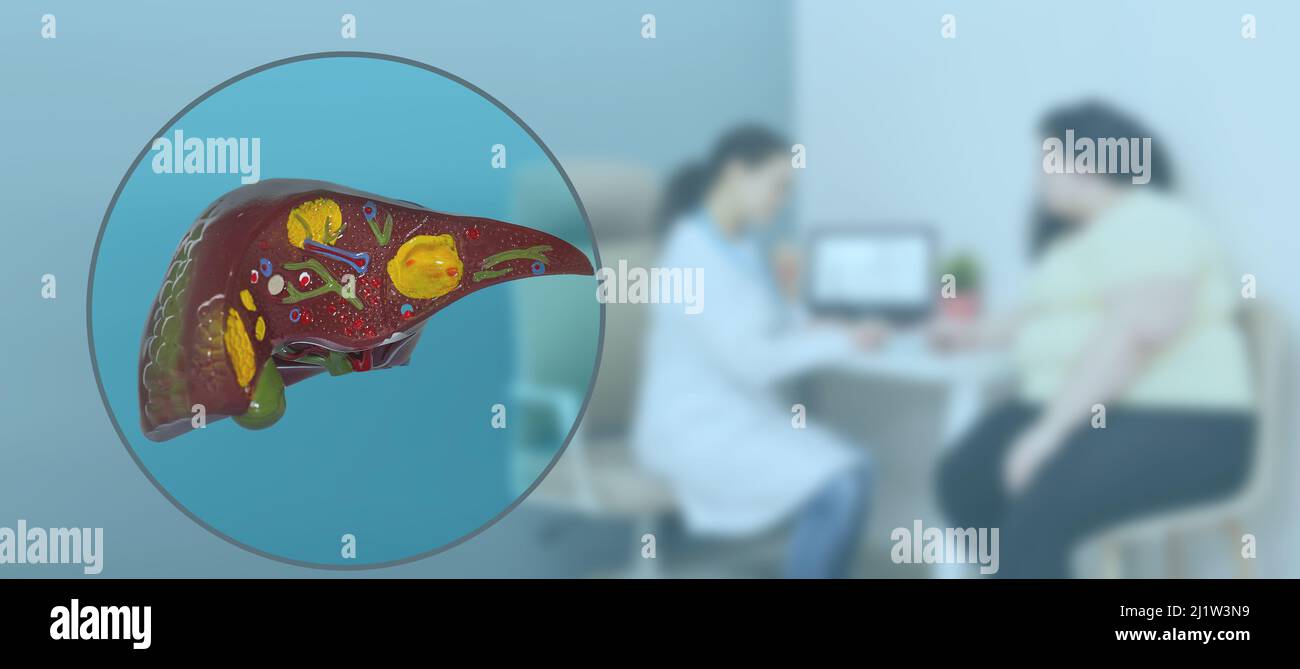 Leberprobleme bei übergewichtigen Menschen. Anatomisches Modell der menschlichen Leber, das Lebererkrankungen, Hepatitis und Zirrhose zeigt, über Hintergrund Arzt consultati Stockfoto