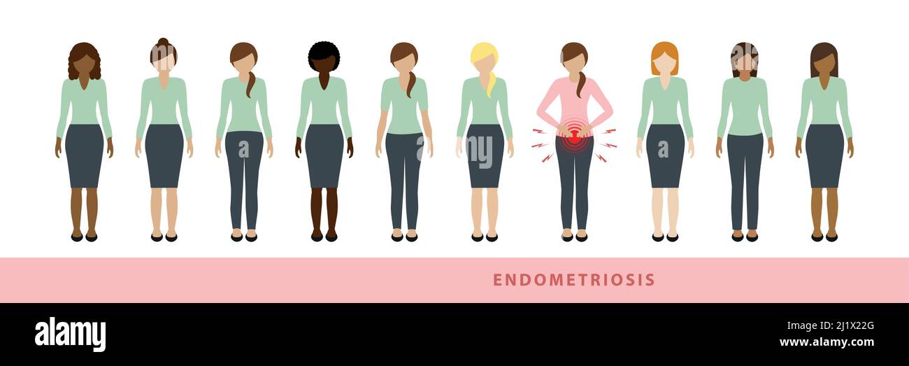 Eine von zehn Frauen hat Endometriose Illustration von verschiedenen Frauen eine mit Bauchschmerzen Stock Vektor