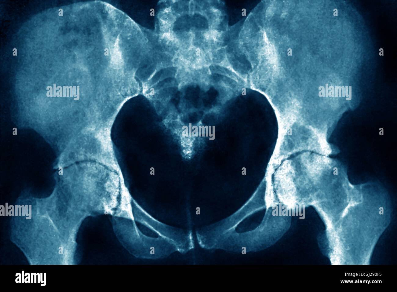 Arthrose der Hüften Stockfoto