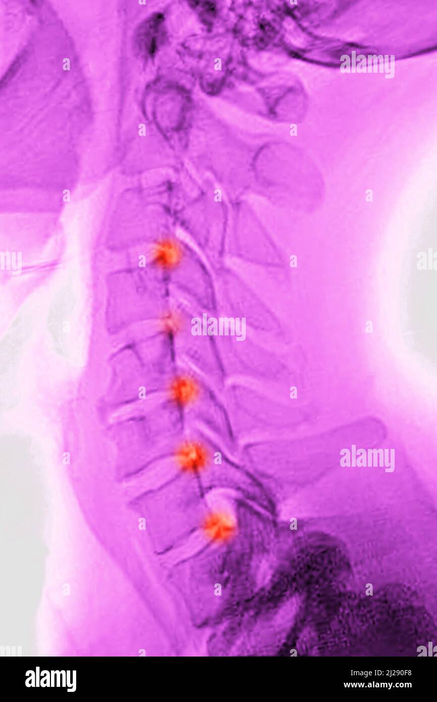 Zervikale Arthrose Stockfoto
