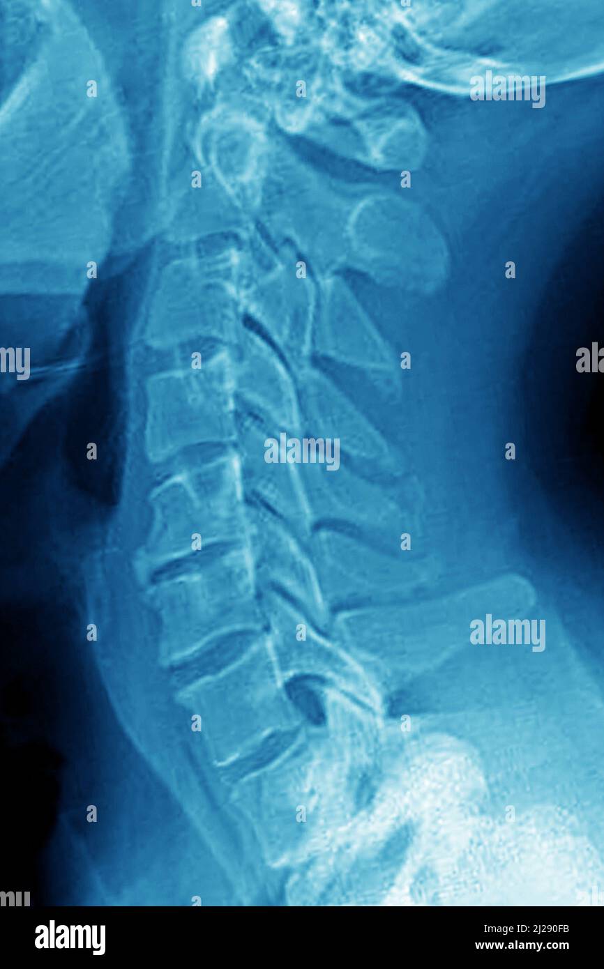 Zervikale Arthrose Stockfoto