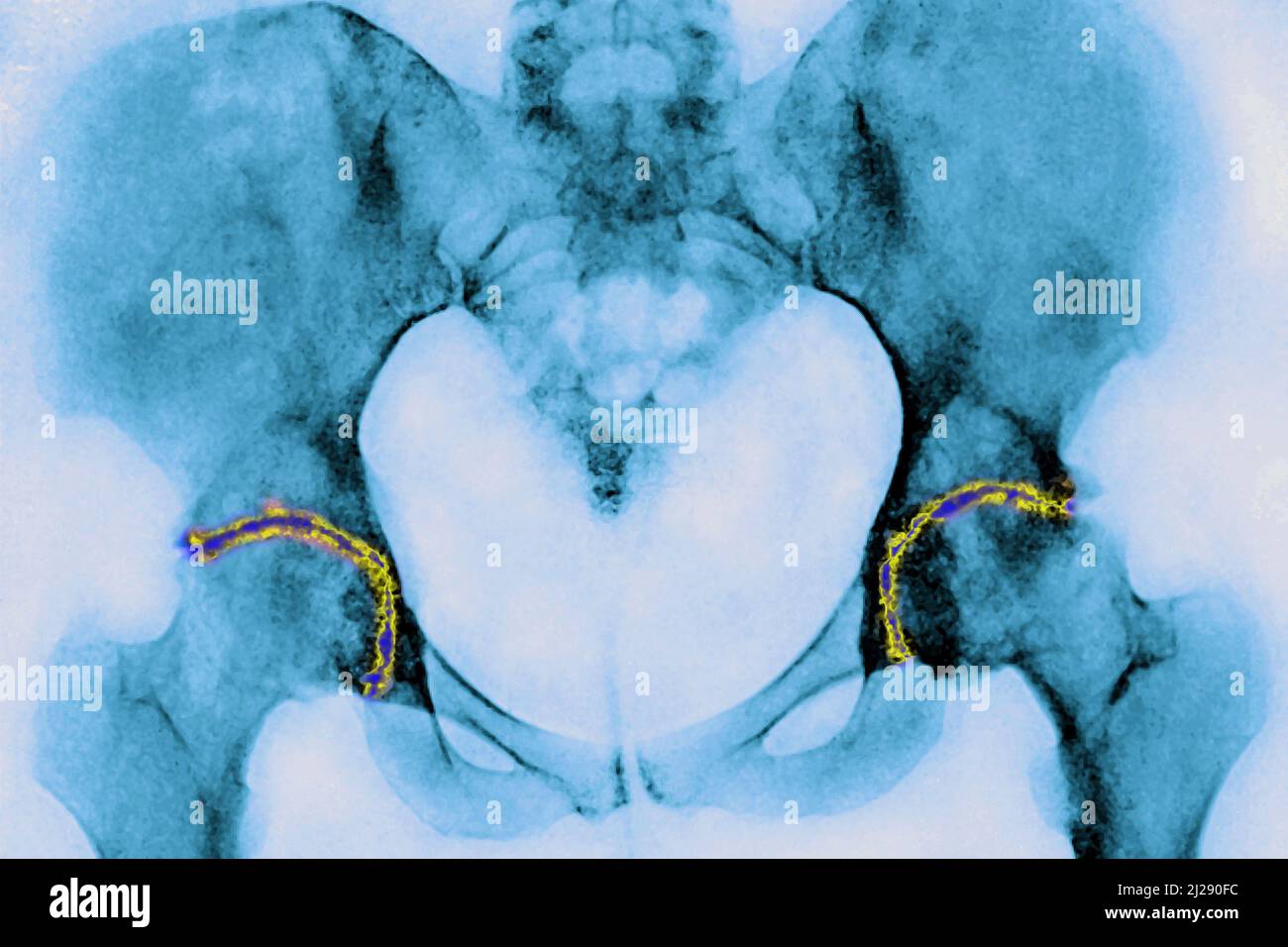 Arthrose der Hüften Stockfoto