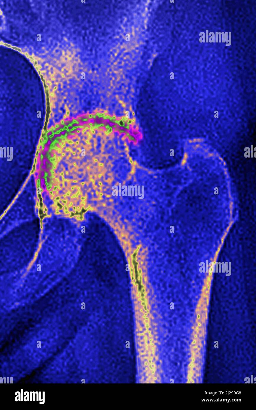 Arthrose der Hüfte Stockfoto