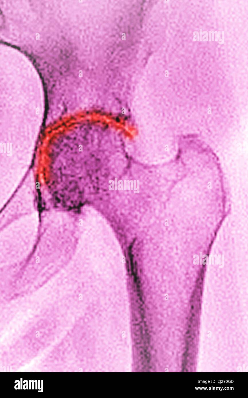 Arthrose der Hüfte Stockfoto