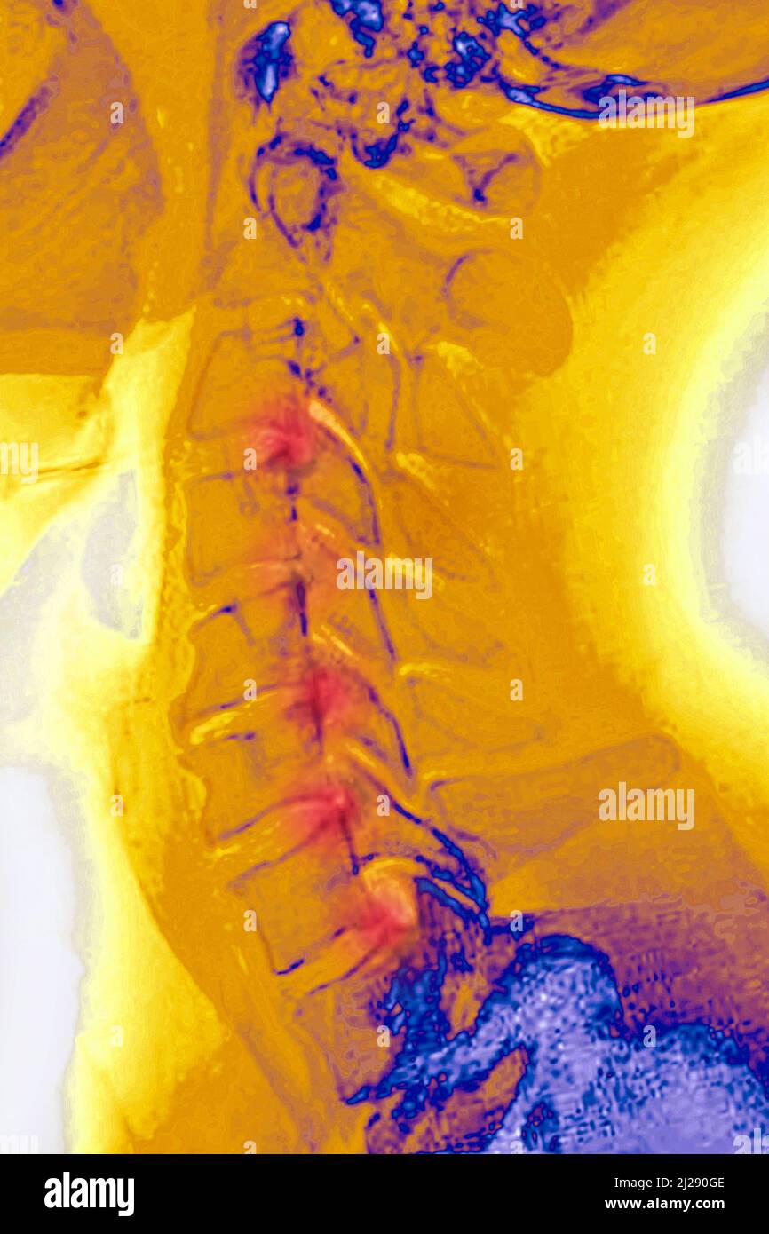 Zervikale Arthrose Stockfoto
