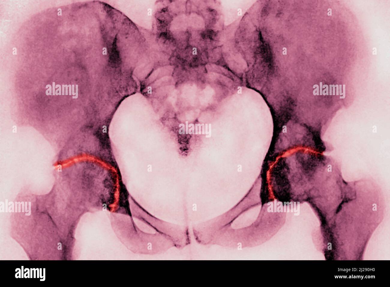 Arthrose der Hüften Stockfoto