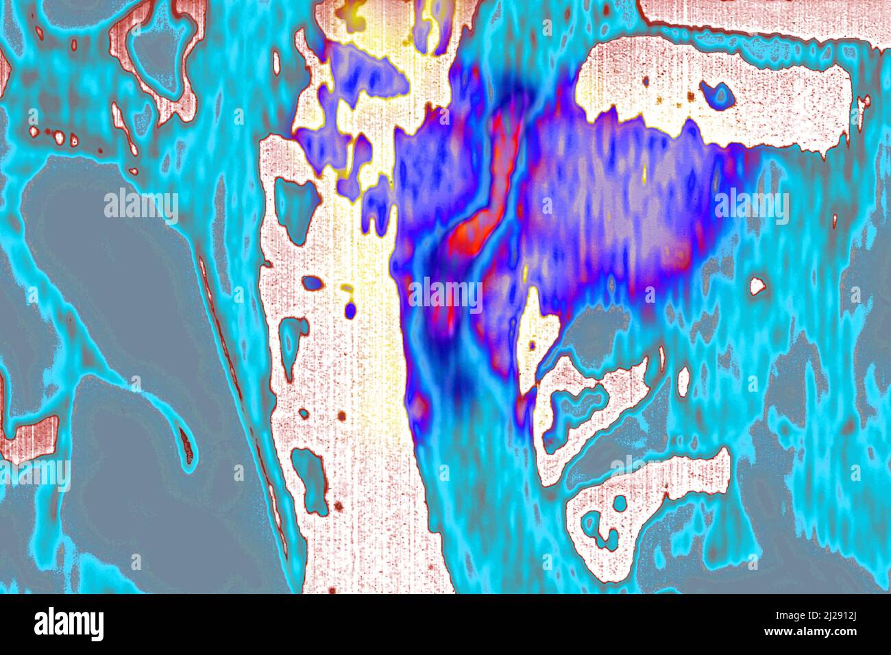 Maligner Tumor auf Halswirbeln lokalisiert Stockfoto