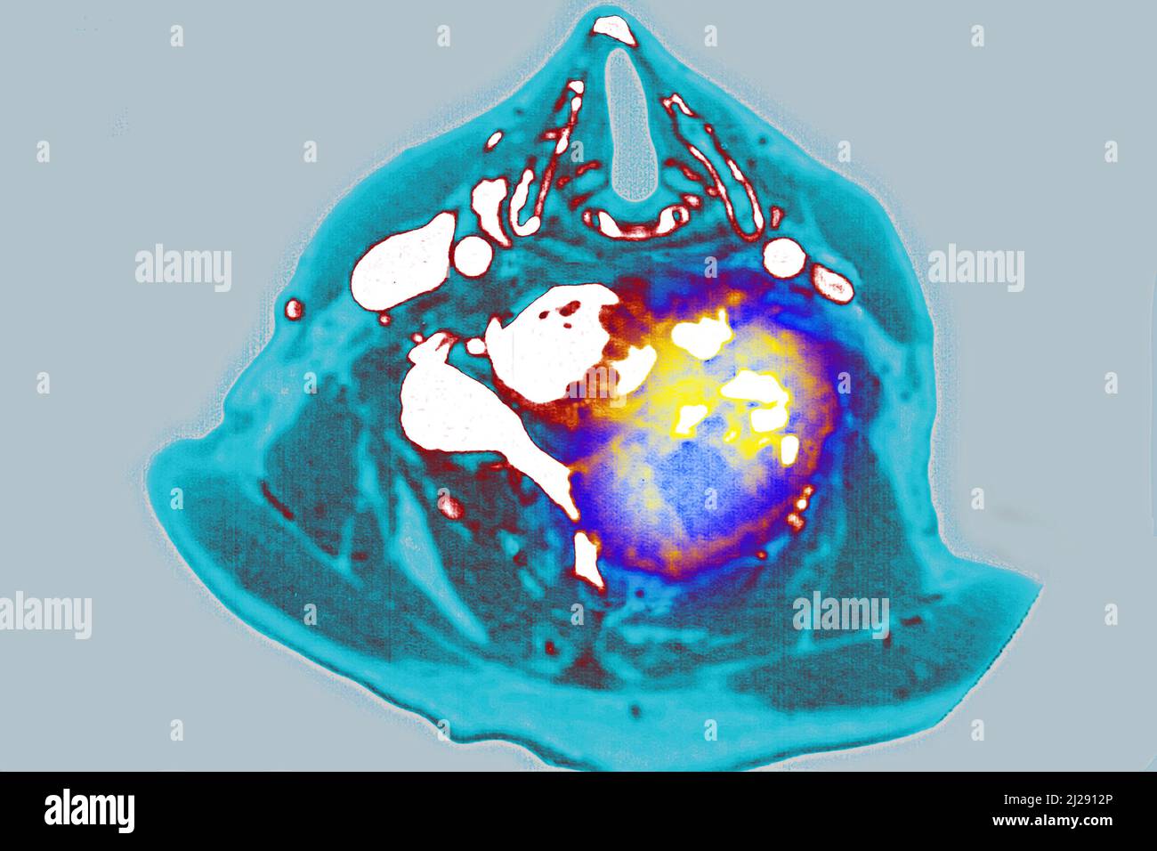 Maligner Tumor auf Halswirbeln lokalisiert Stockfoto