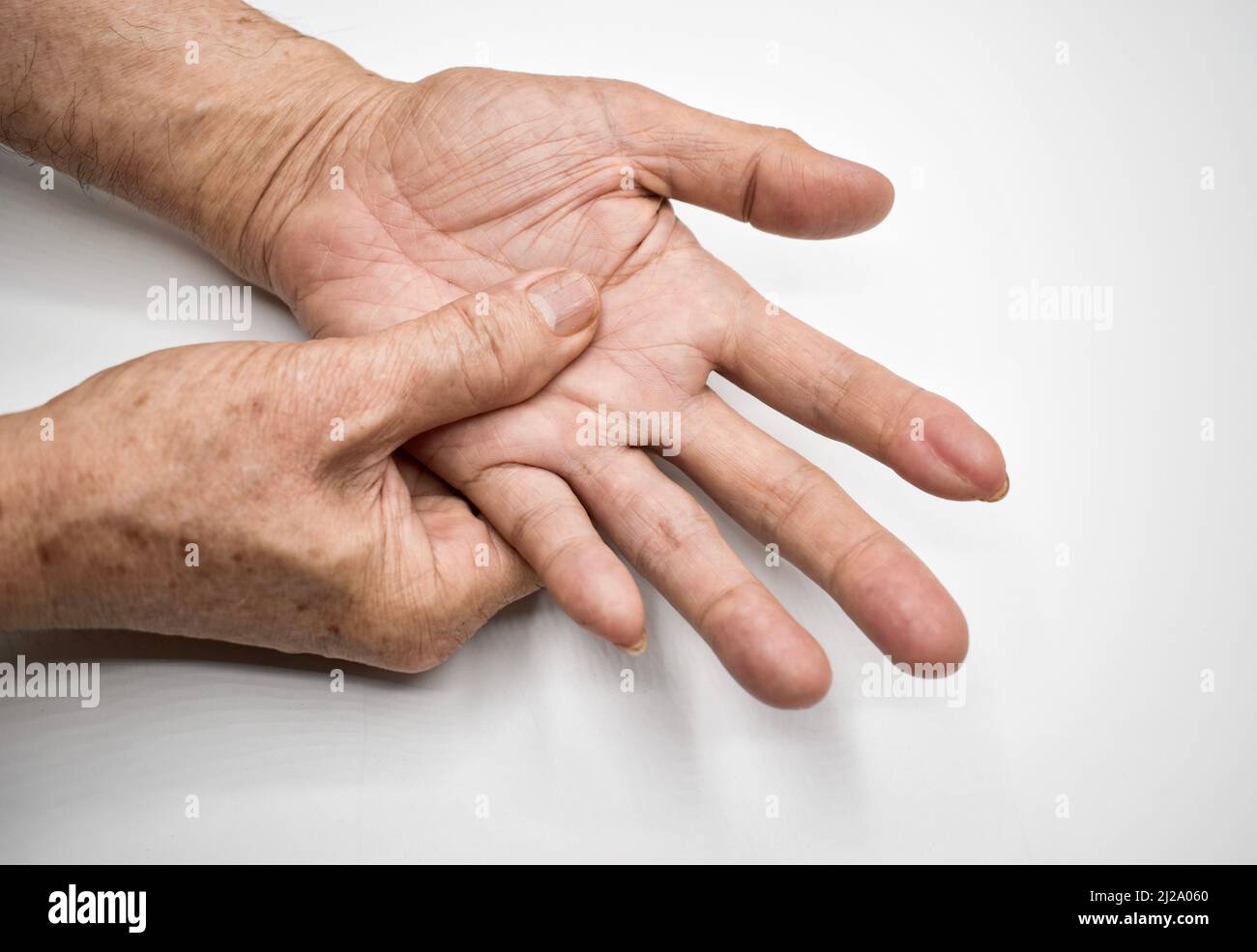 Schmerzhafter Palmaraspekt des asiatischen alten Mannes. Konzept des Kompartiment-Syndroms und Schmerzen der Handmuskulatur. Stockfoto