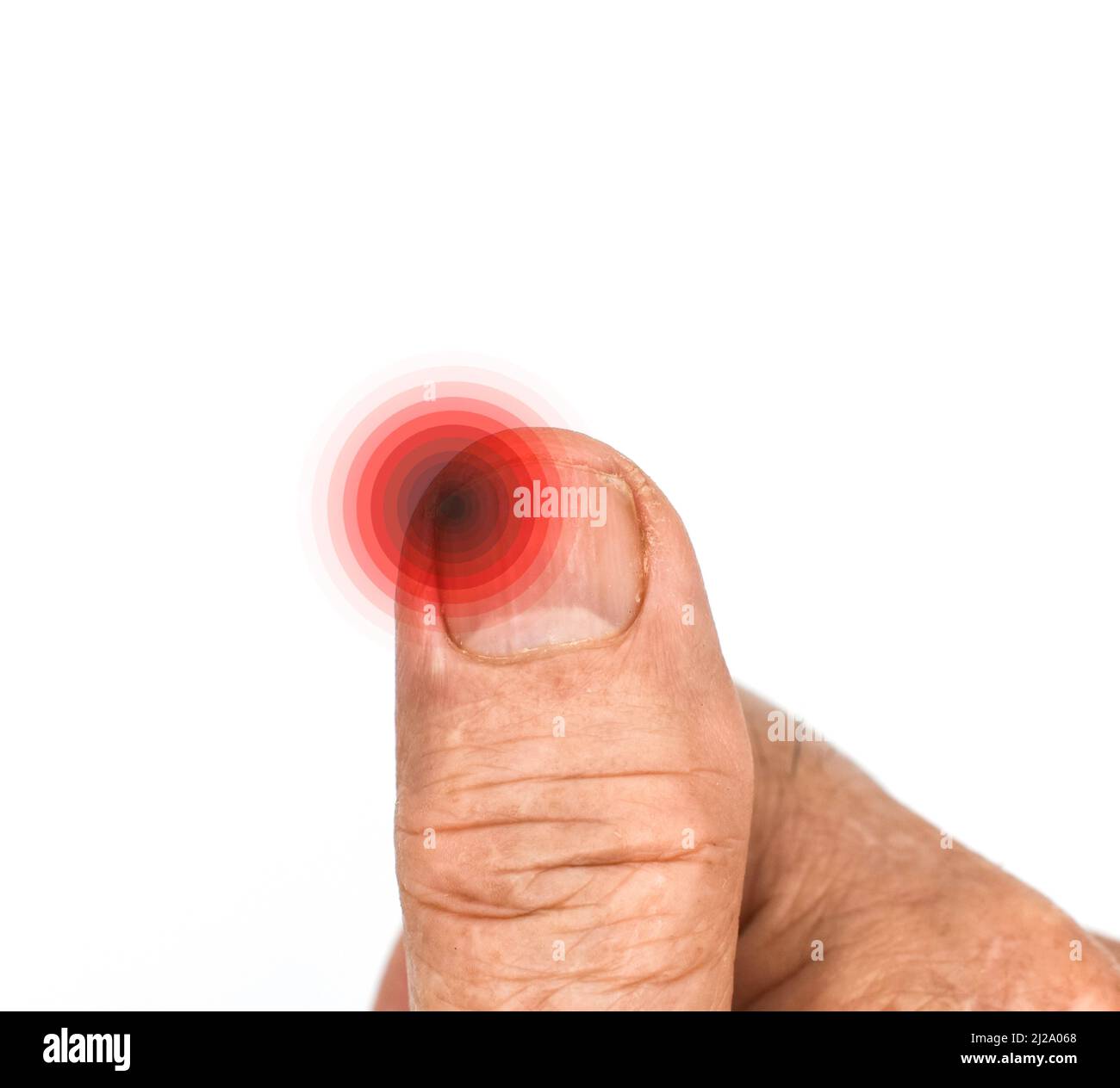 Entzündung an der Spitze des Fingernagels. Konzept der Paronychie am Daumen des asiatischen alten Mannes. Schmerzhafter Finger. Stockfoto