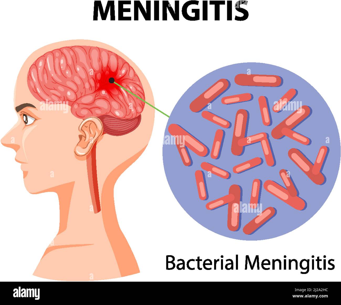 Diagramm mit Meningitis auf menschlicher Illustration Stock Vektor