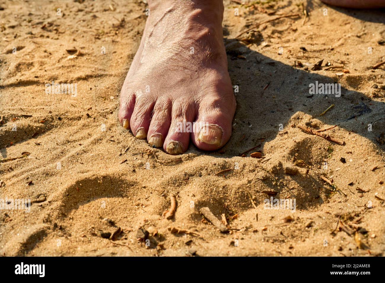 Fuß eines älteren Mannes mit gebrochenen alten Nägeln auf dem Sand Stockfoto