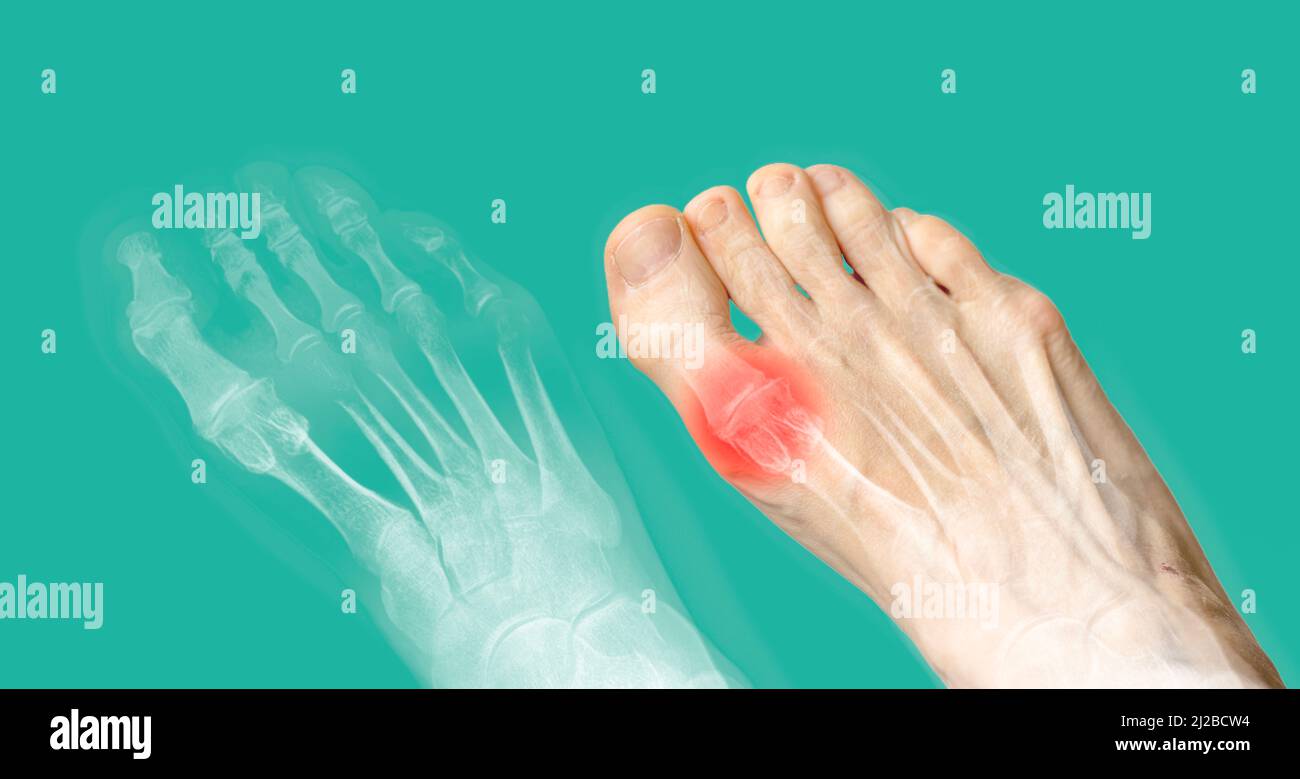 Röntgen und den gleichen Fuß mit roten Schmerzen. Rheumatoide Arthritis. Arthrose Stockfoto