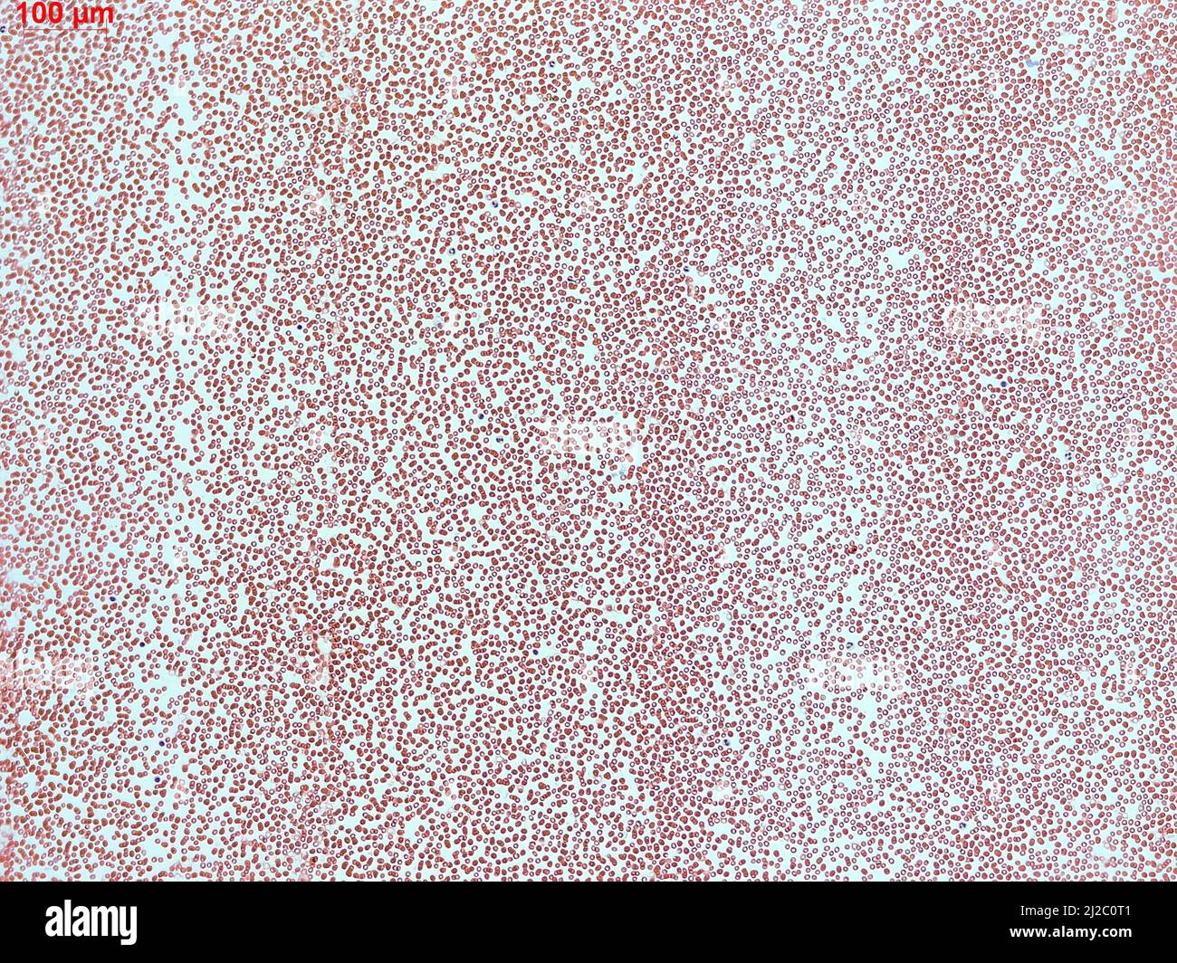 Menschliche Blutkörperchen unter dem Mikroskop. Vergrößerter Abstrich von roten Blutkörperchen im Blutplasma. Stockfoto