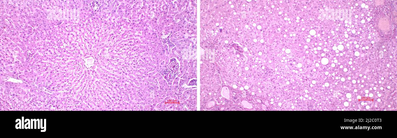 Lichtmikroskopie der Leber. Vergleich der Struktur (Histologie) einer gesunden menschlichen Leber (links) und der von einer Fetterkrankung betroffenen Leber (rechts) Stockfoto