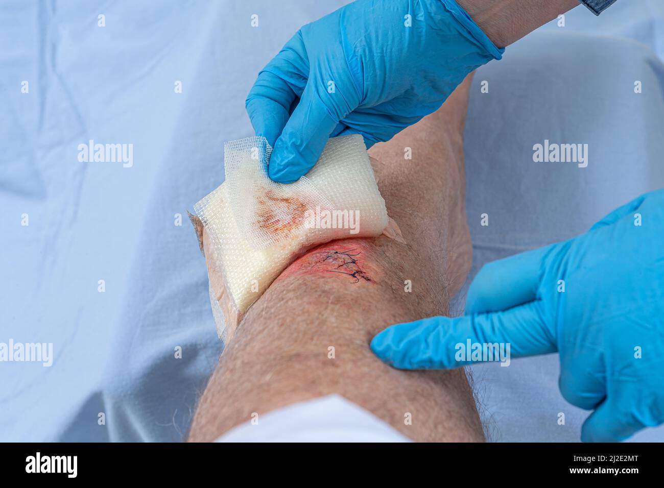 Krankenschwester Pflege frisch blutige Verletzung Wunde auf dem Tibiabaum des Beins. Klebende Stiche, um den Schnitt zu halten. Stockfoto