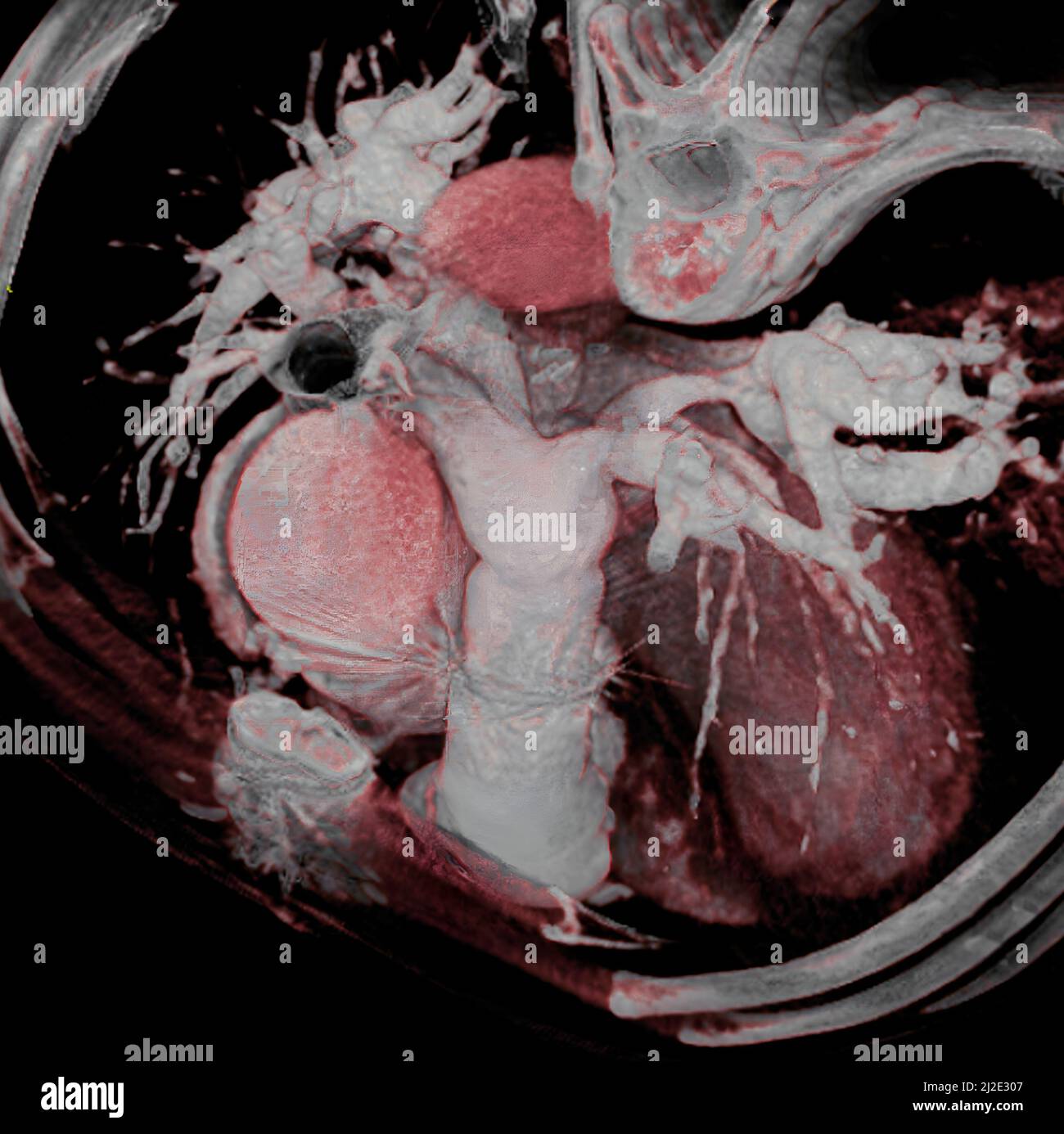 Prothese, Arterie Stockfoto