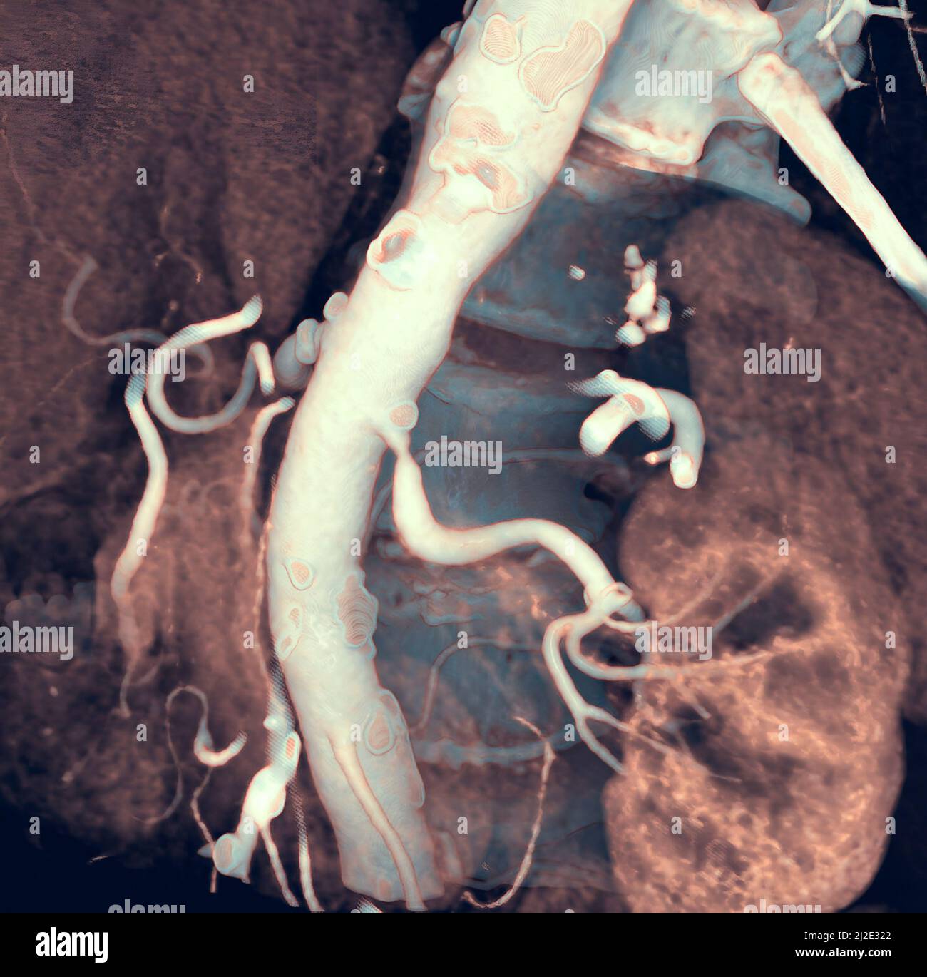 Stenose der linken Nierenarterie Stockfoto